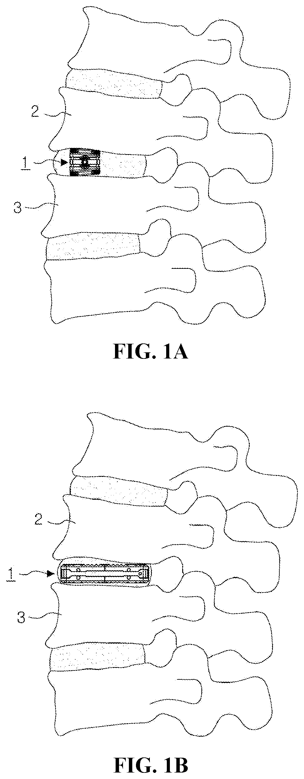 Patent US12599488 — Bi-planar expandable cage for spine — Figure 1