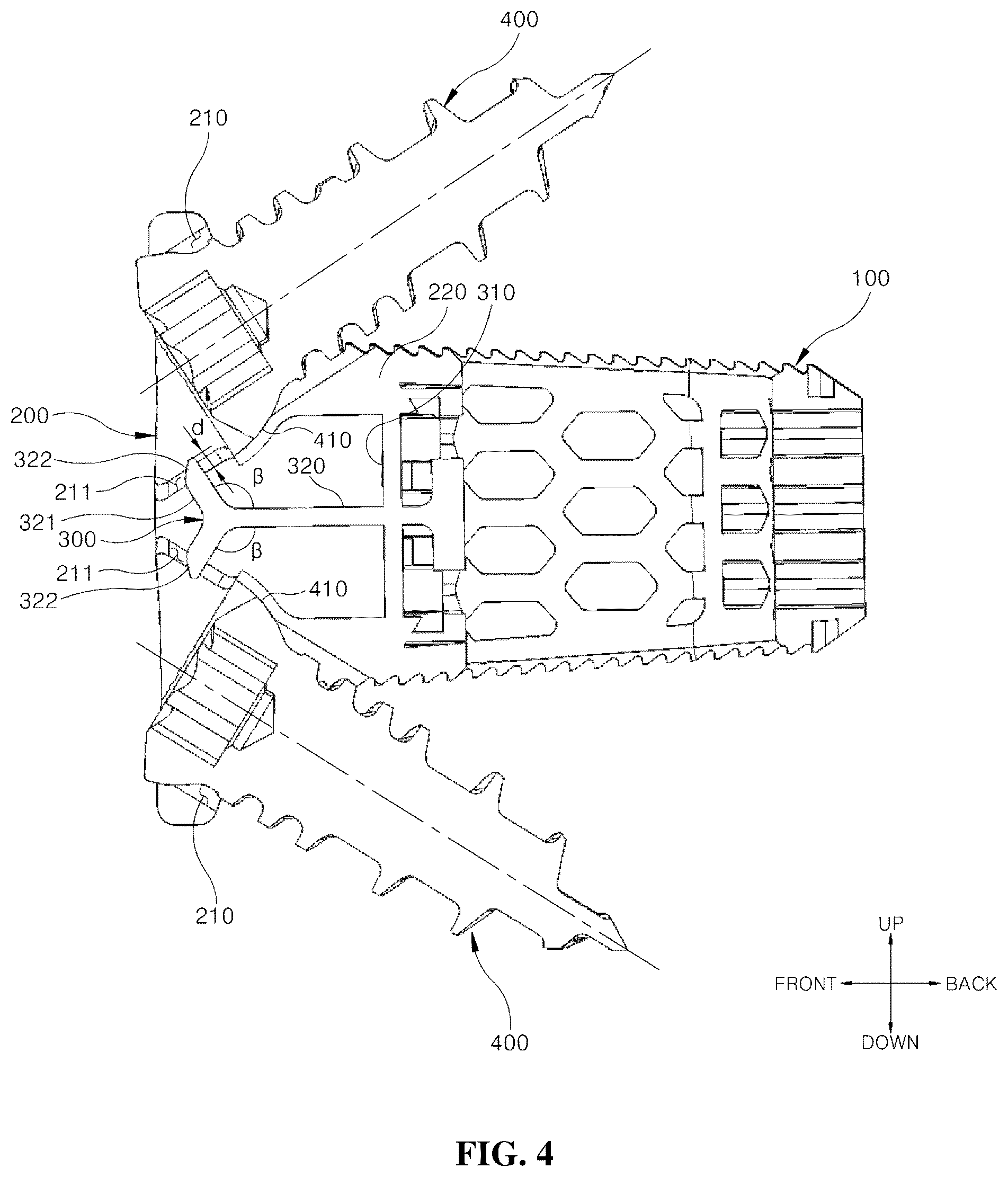 Patent US12599489 Figure 4 – Spinal cage fixable through insertion of bone screws