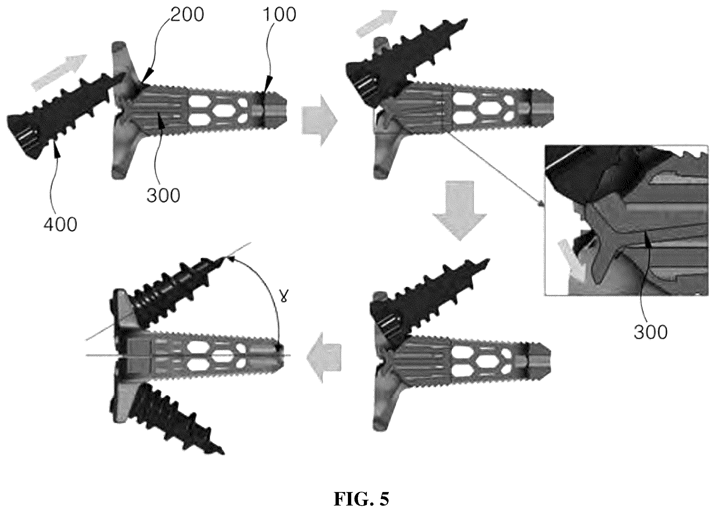 Patent US12599489 Figure 5 – Spinal cage fixable through insertion of bone screws