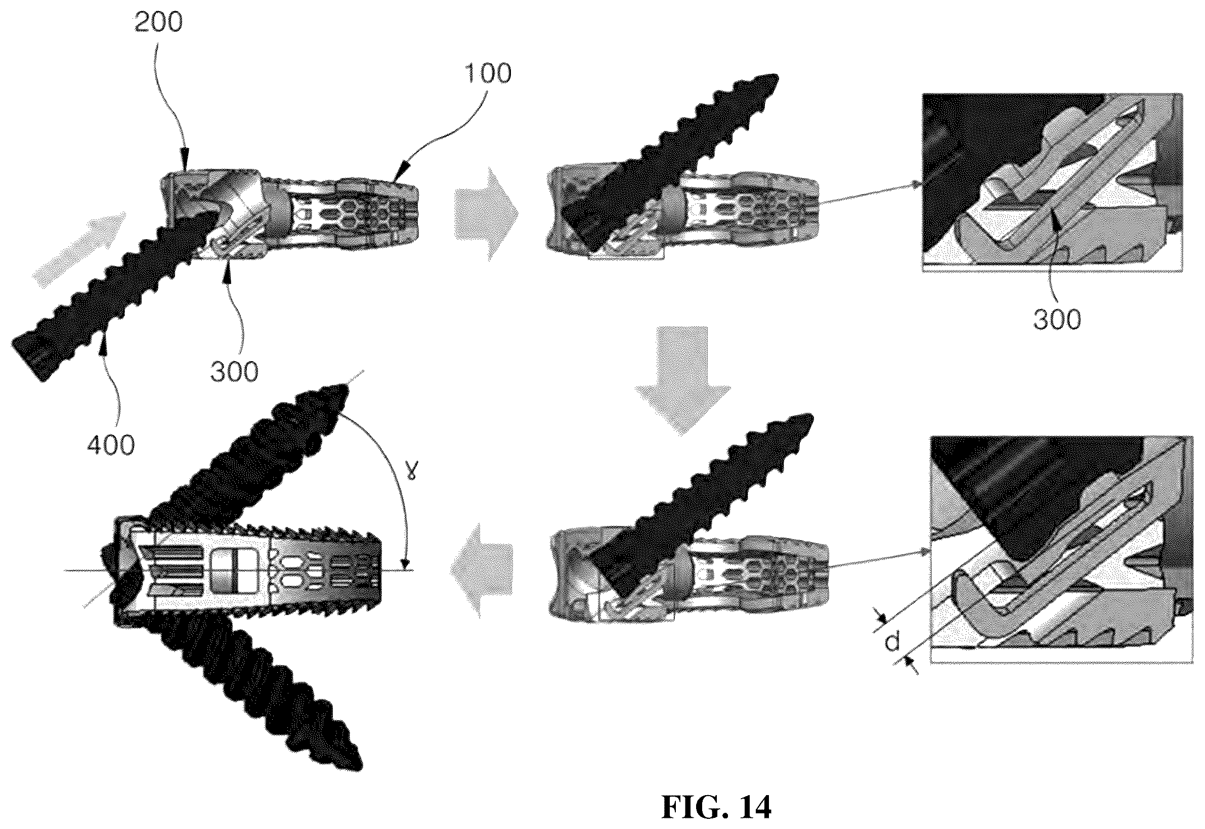 Patent US12599489 Figure 14 – Spinal cage fixable through insertion of bone screws