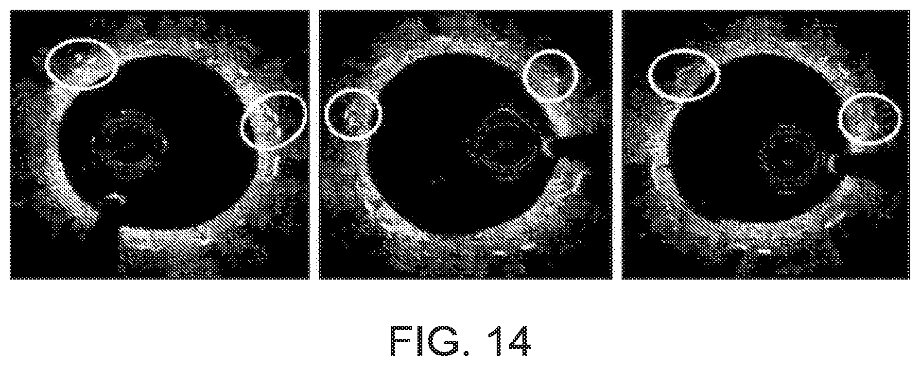 Patent US12599490 Figure 11 – Uncaging stent