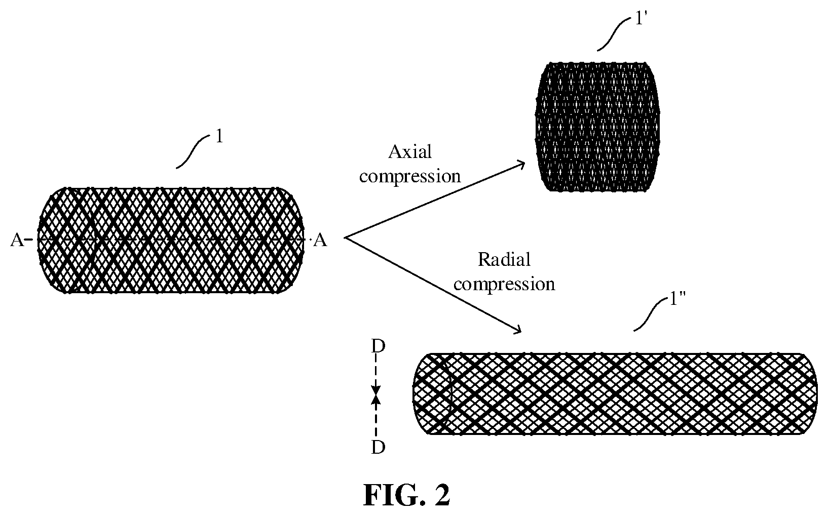 Patent US12599492 Figure 2 – Axially compressible bare stent