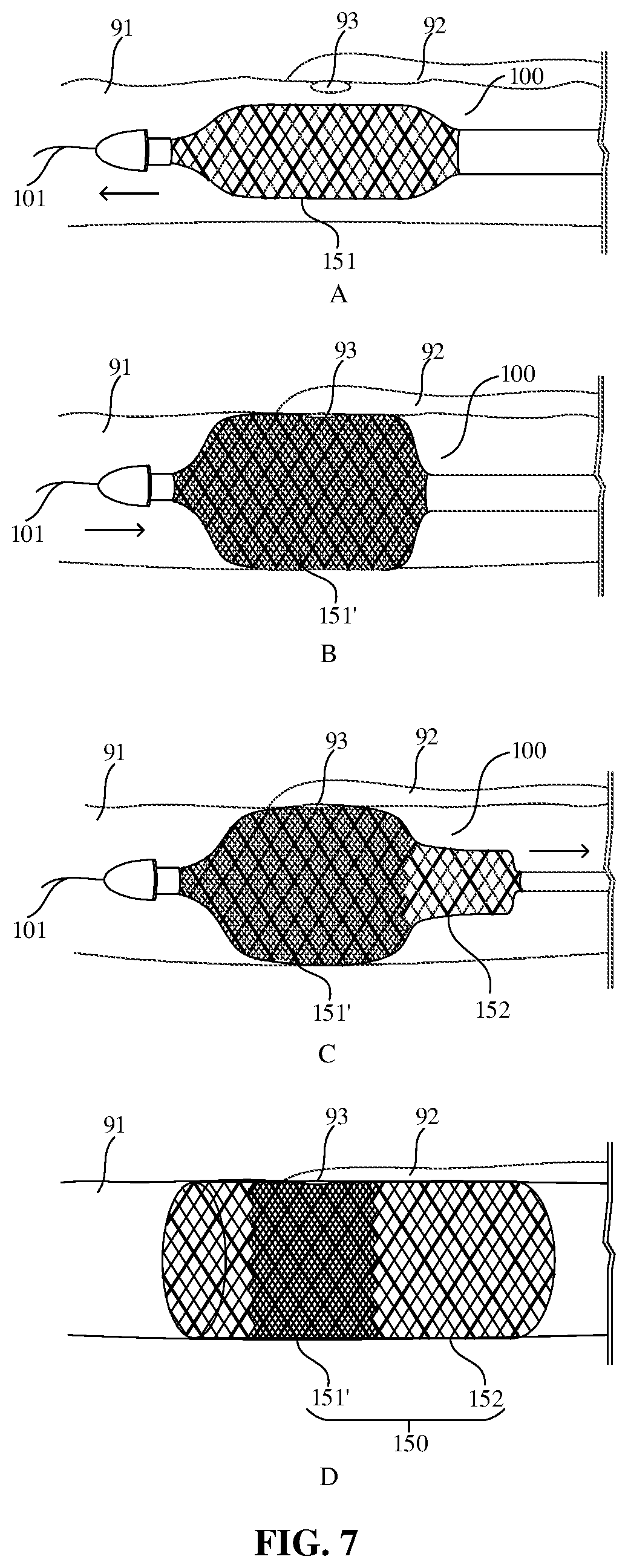 Patent US12599492 Figure 7 – Axially compressible bare stent
