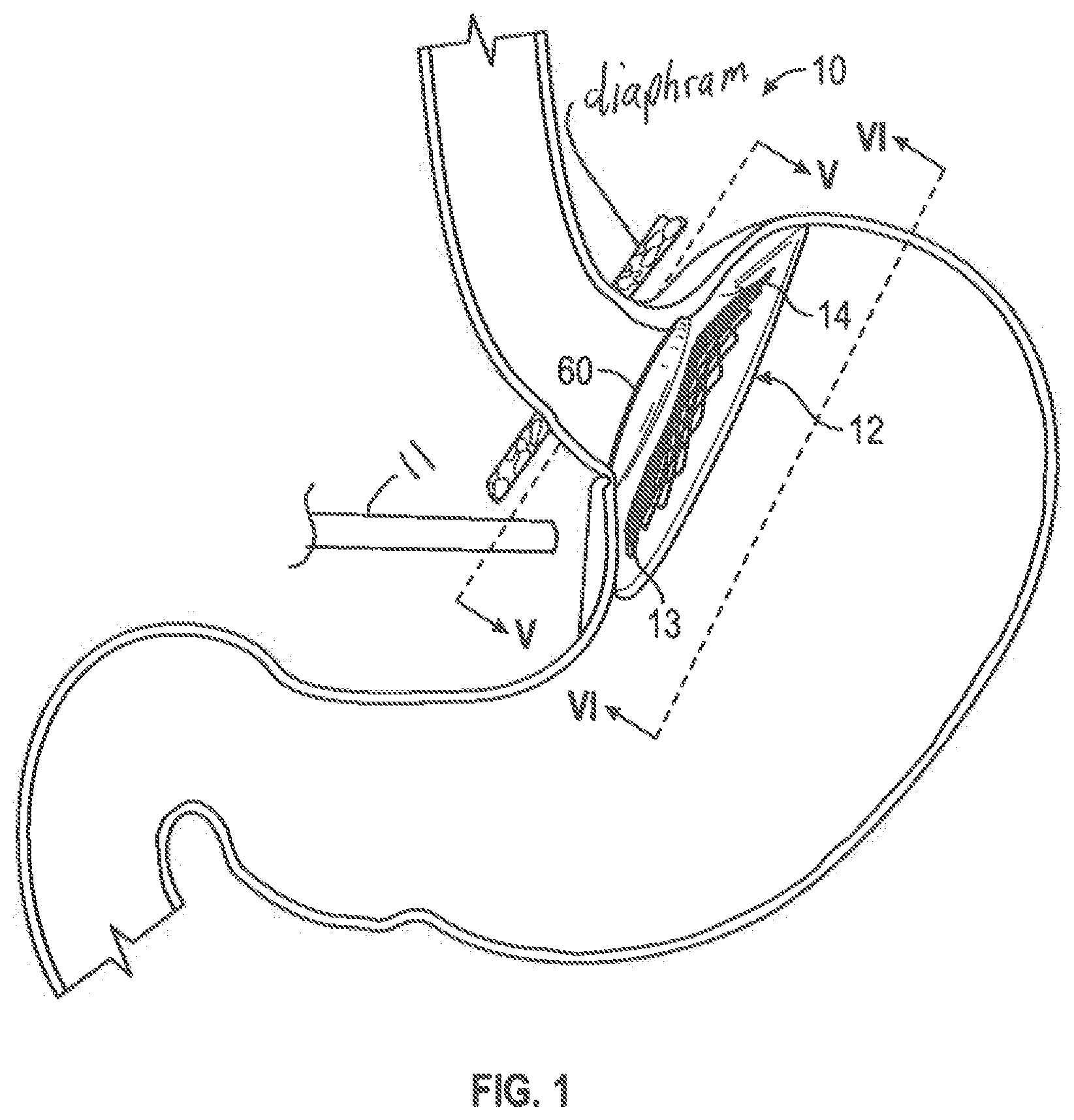 Patent US12599493 Figure 1 – Method of deploying an intraluminal device and intraluminal system