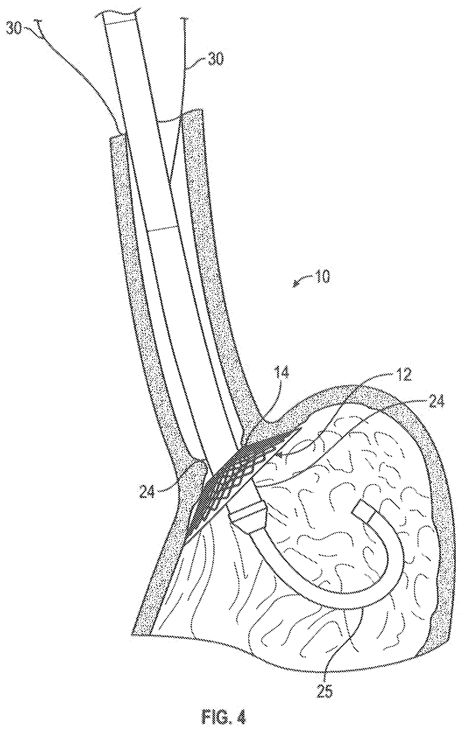 Patent US12599493 Figure 4 – Method of deploying an intraluminal device and intraluminal system