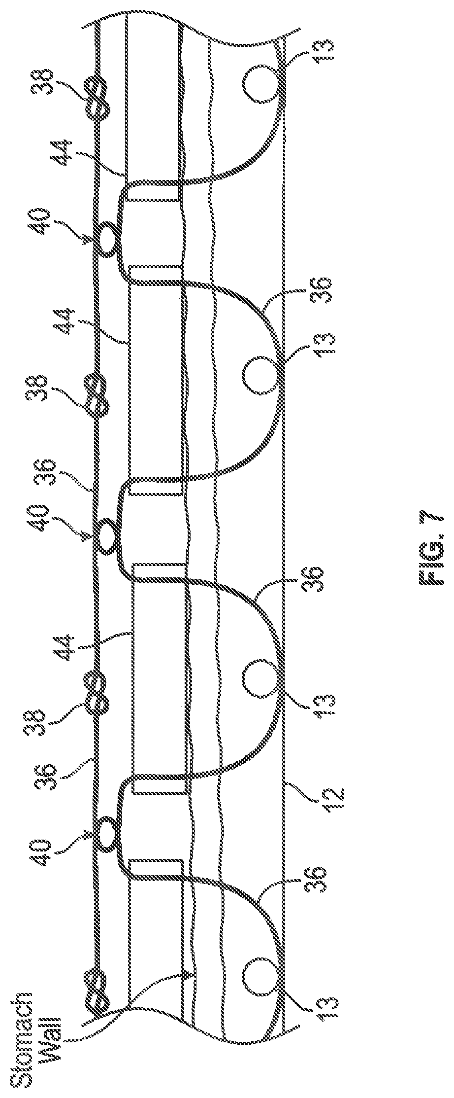 Patent US12599493 Figure 7 – Method of deploying an intraluminal device and intraluminal system