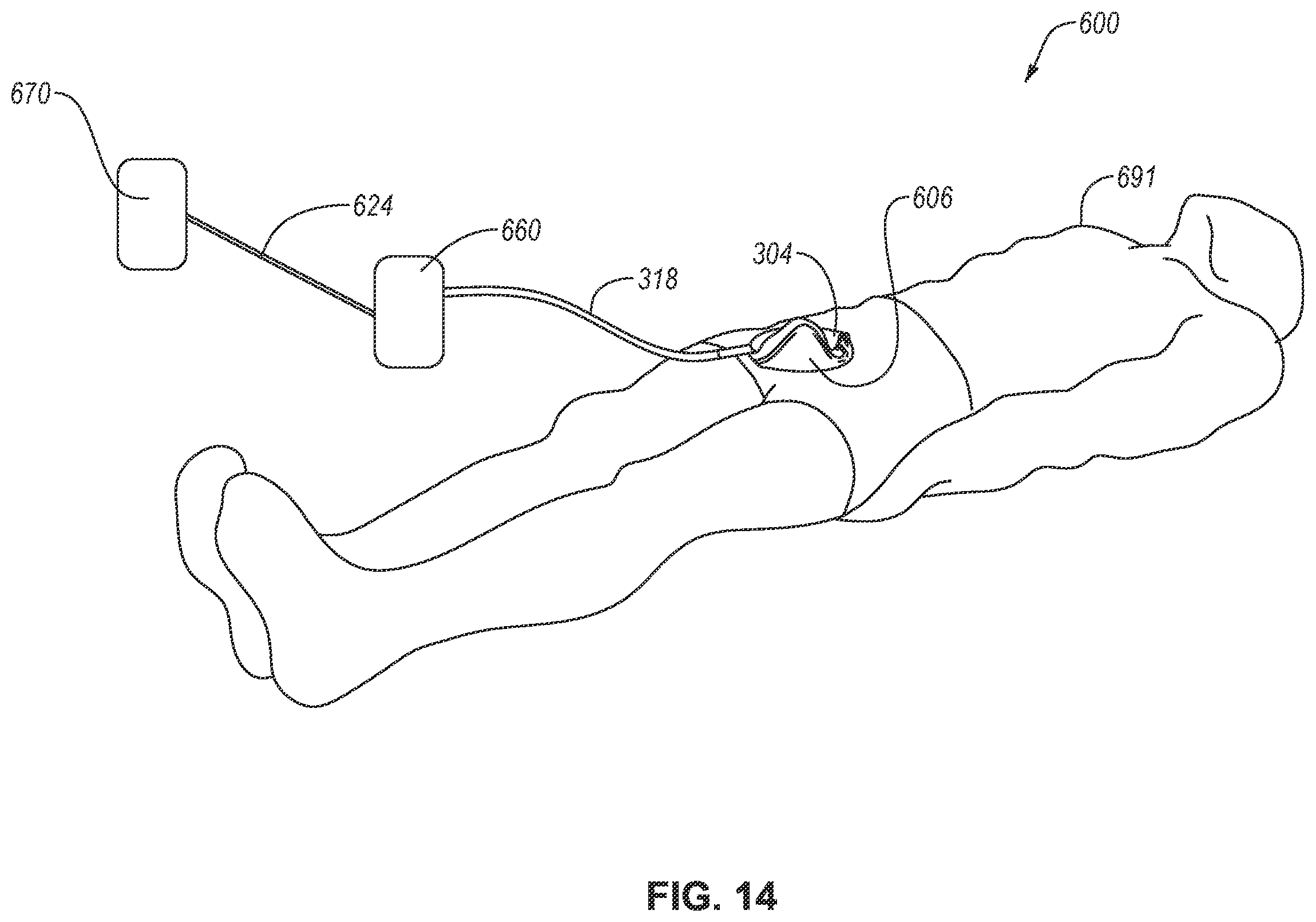 Patent US12599495 Figure 12 – Male external catheter with attachment interface configured to bias against penis