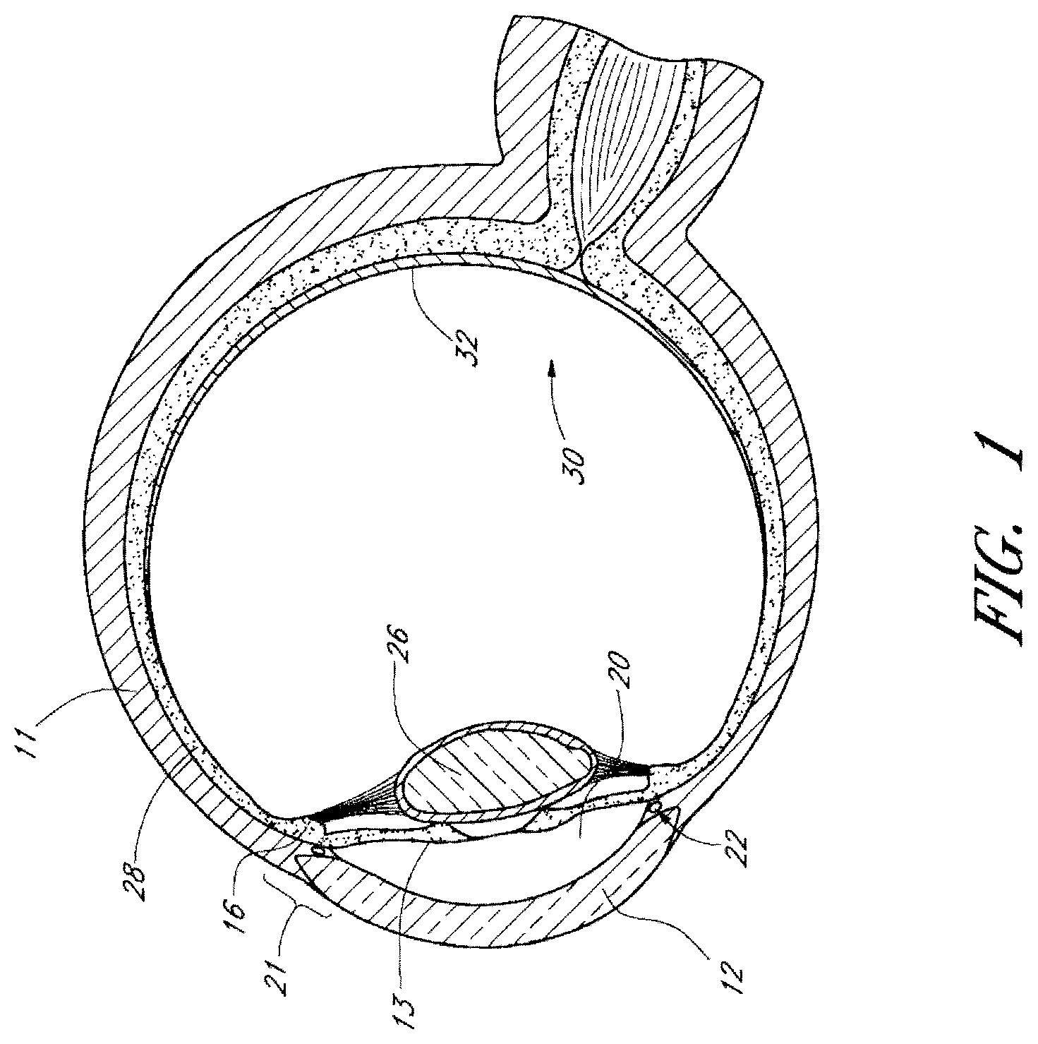 Patent US12599497 Figure 1 – Implants with controlled drug delivery features and methods of using same