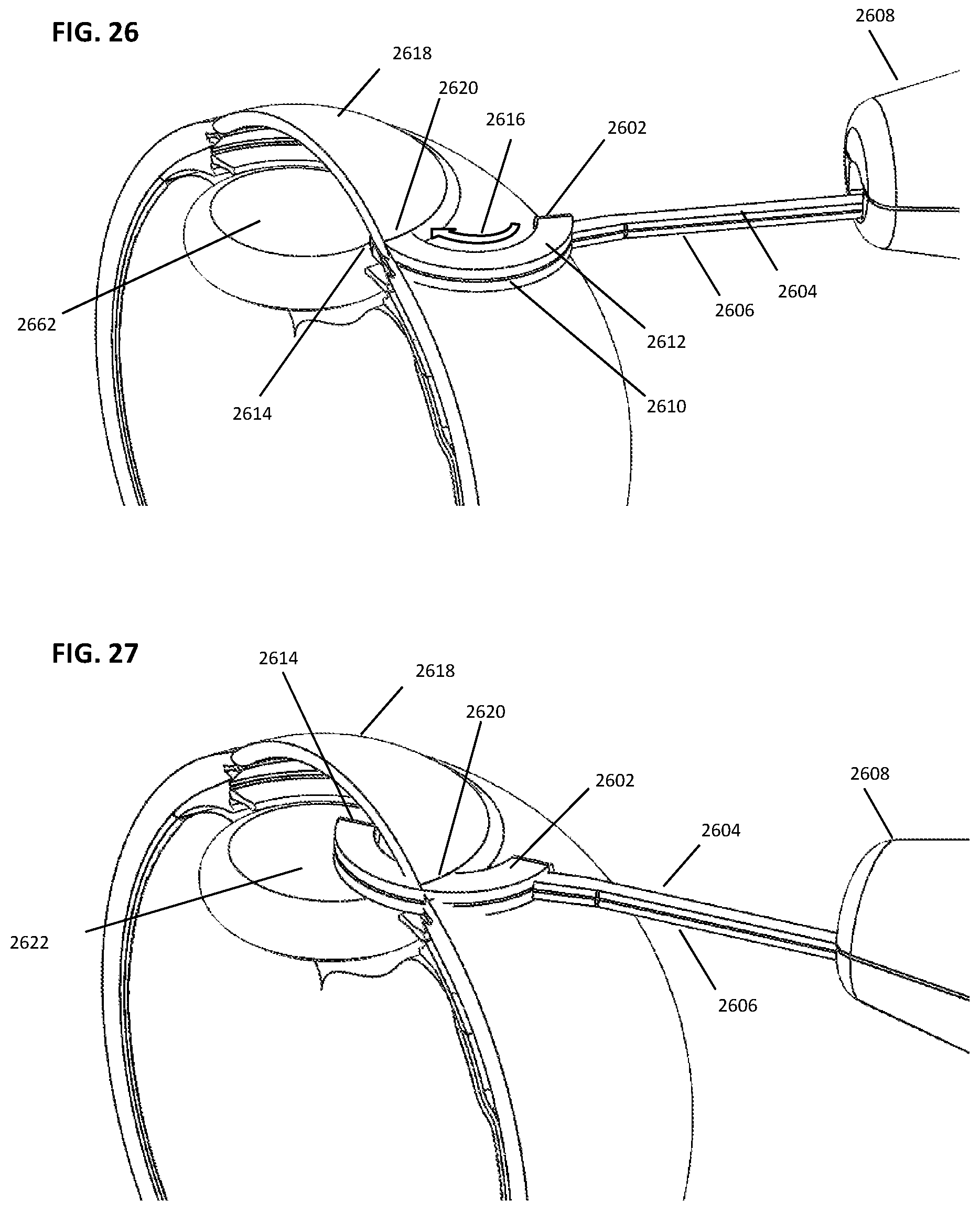 Patent US12599499 Figure 15 – Devices and methods for creating a capsulorhexis
