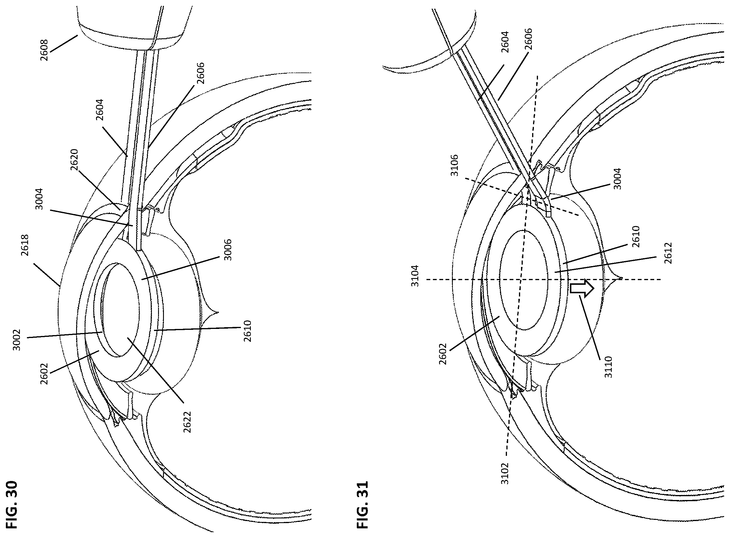 Patent US12599499 Figure 17 – Devices and methods for creating a capsulorhexis