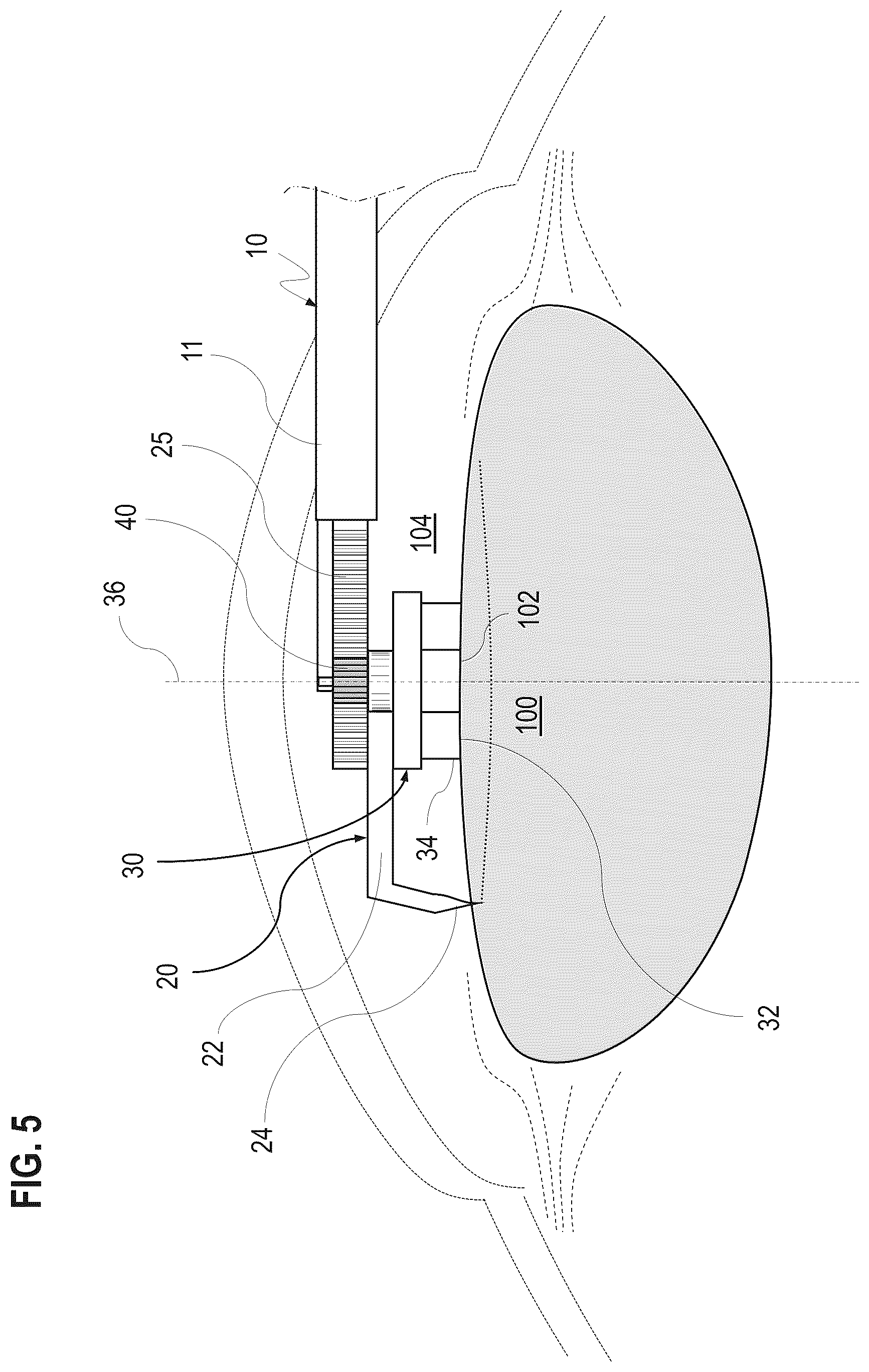 Patent US12599500 Figure 5 – Ophthalmological surgical instrument