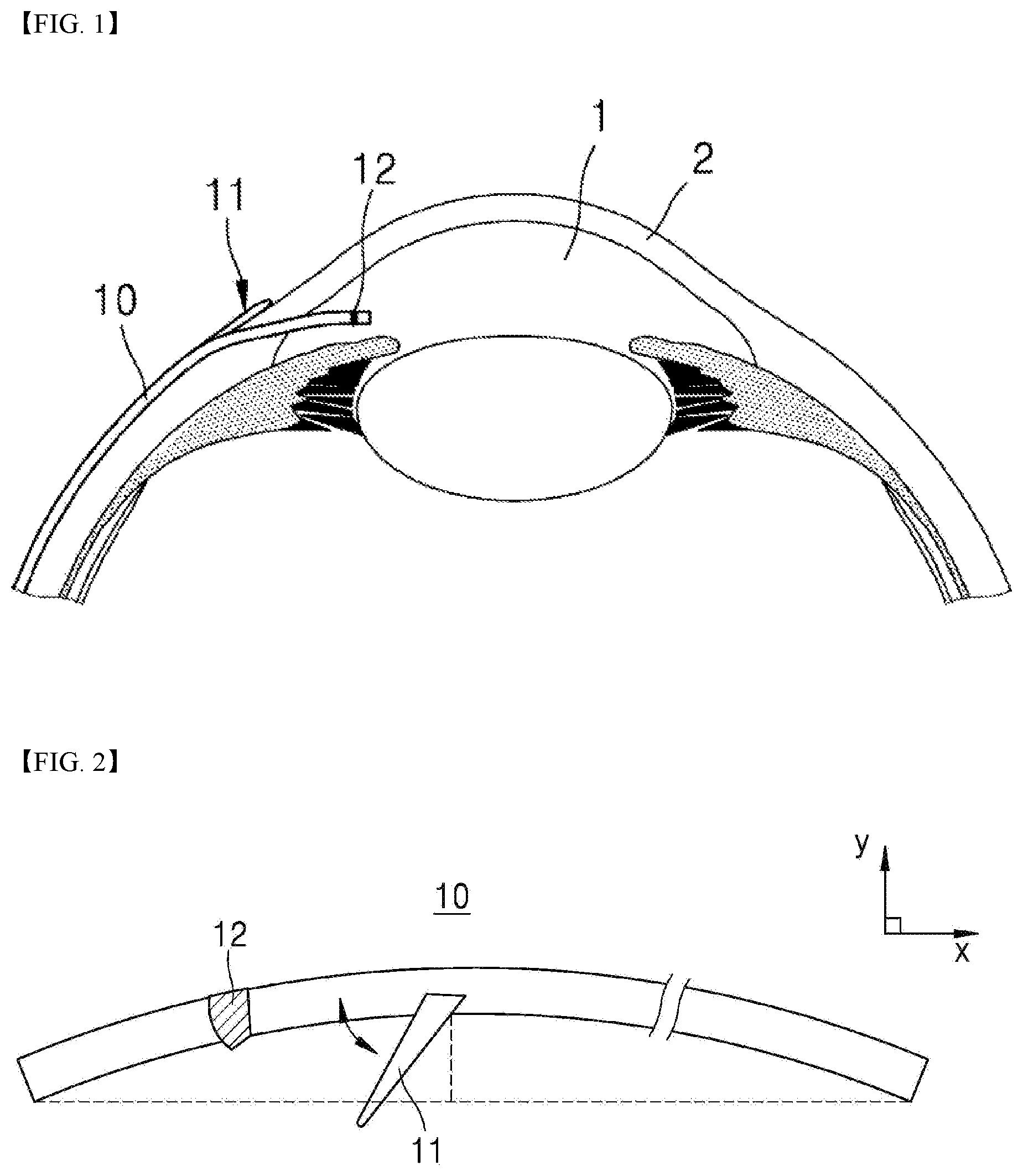 Patent US12599501 Figure 1 – Eye disease implant device capable of lowering eye pressure by easy and safe method