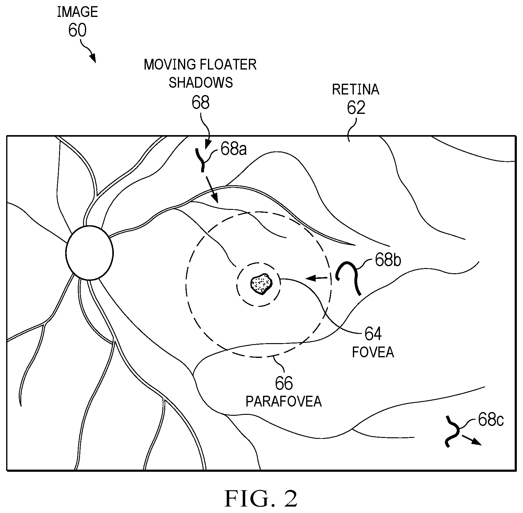 Patent US12599502 Figure 2 – Reducing retinal radiation exposure during laser surgery