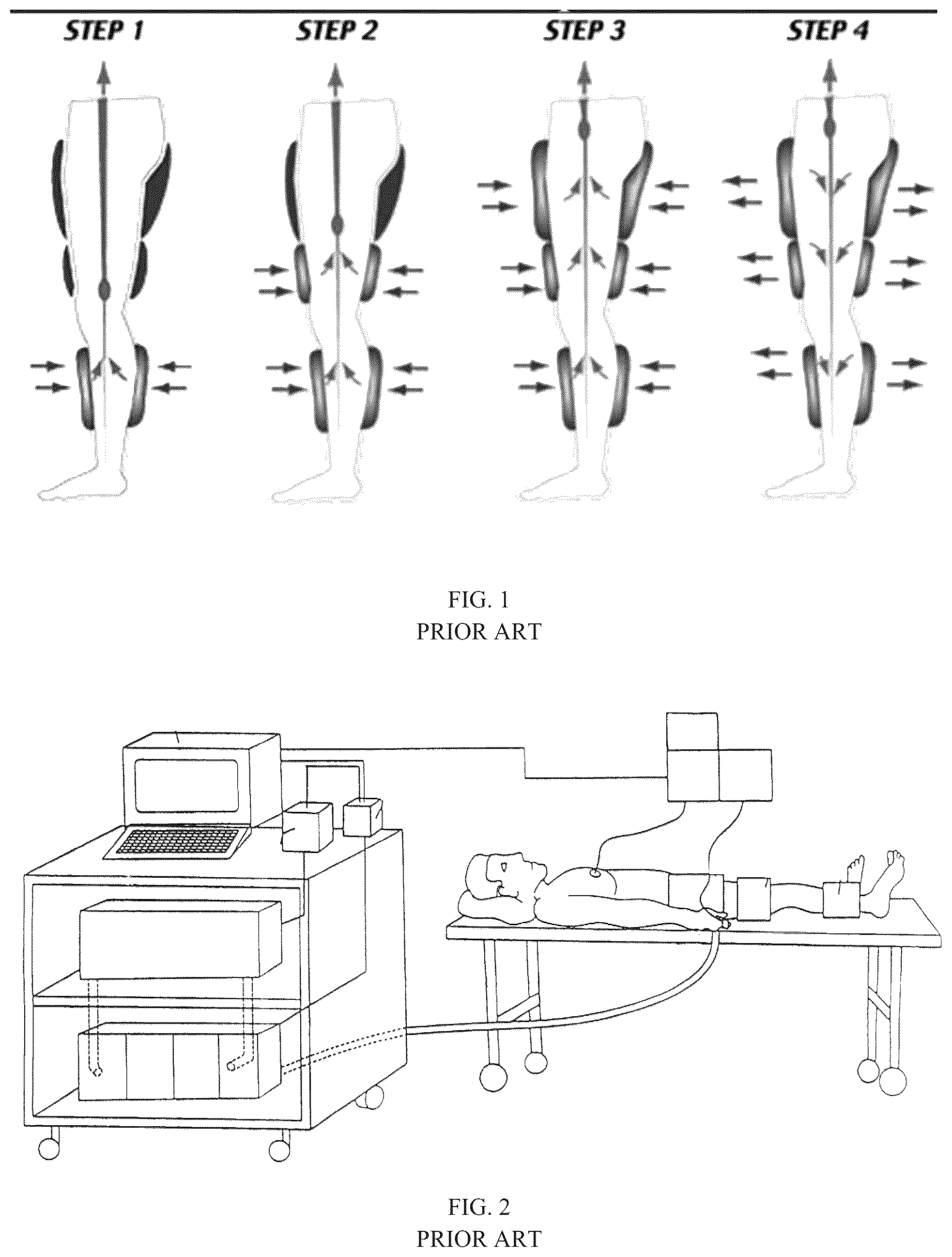 Patent US12599535 Figure 1 – External counterpulsation system
