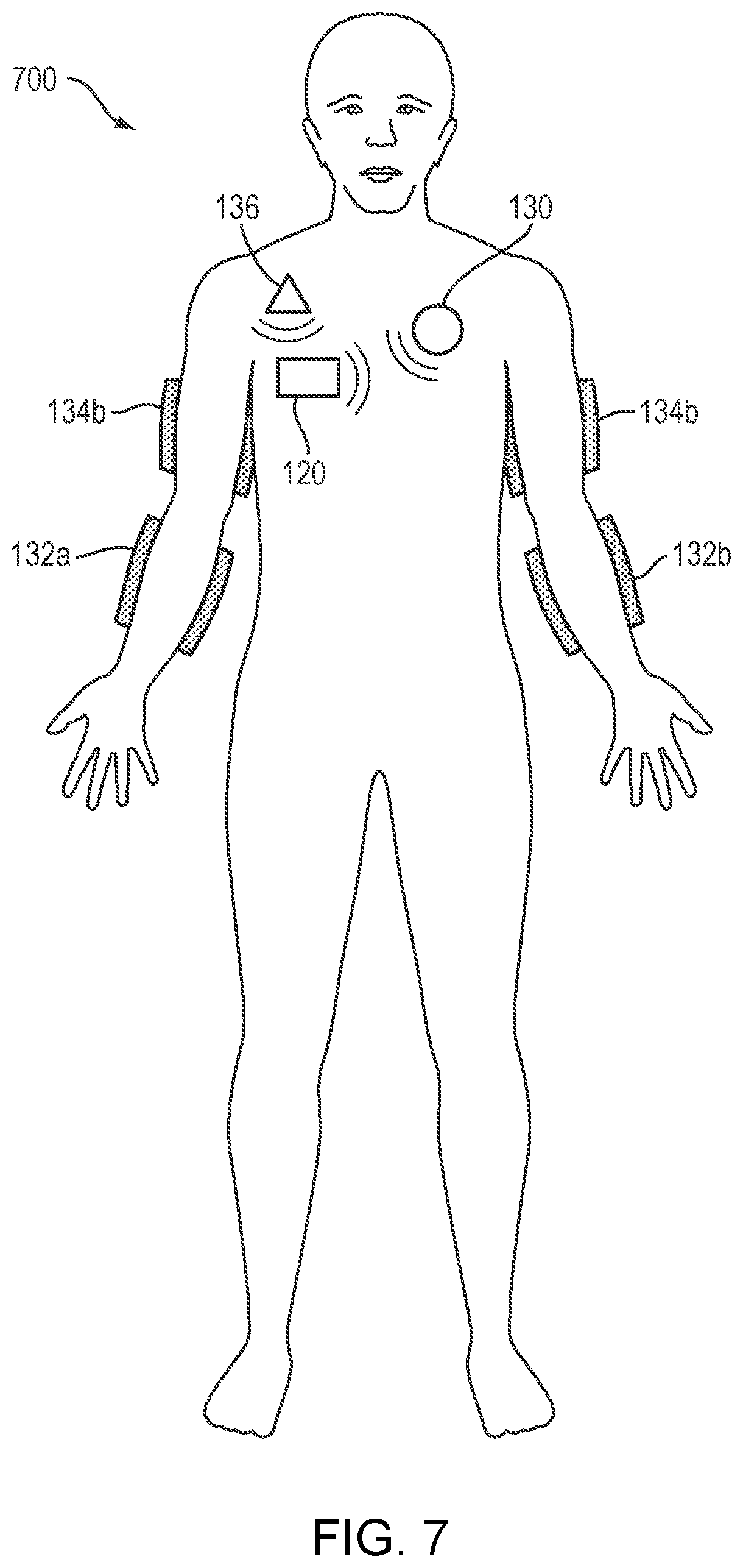 Patent US12599535 Figure 7 – External counterpulsation system