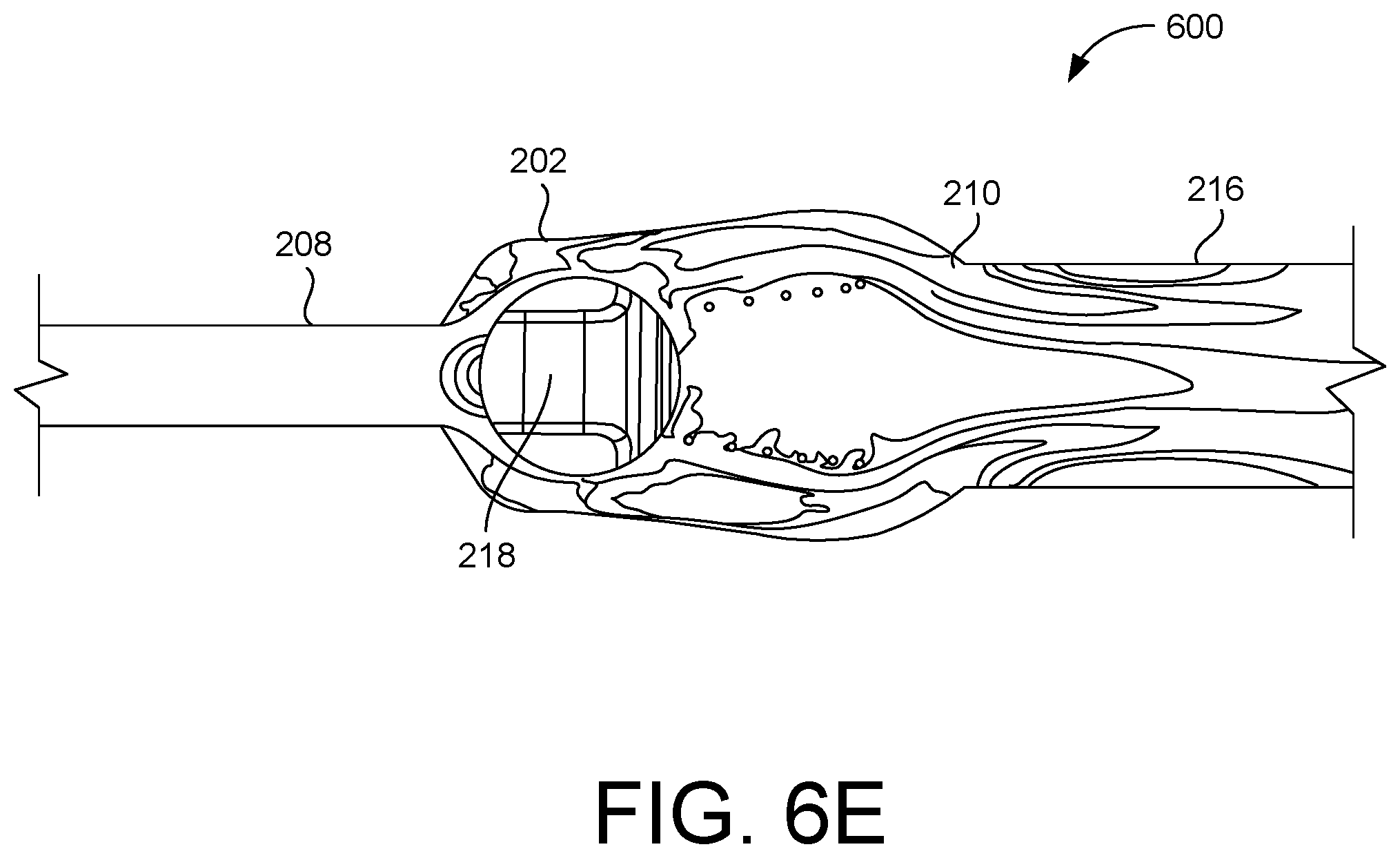 Patent US12599538 Figure 12 – Inflatable penile prosthesis with channels in valve of guide assembly