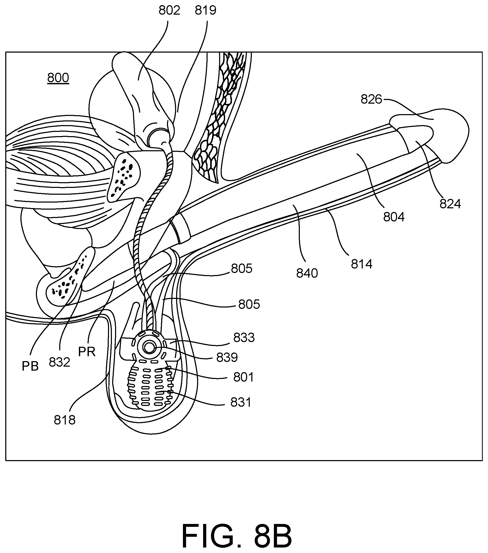 Patent US12599538 Figure 17 – Inflatable penile prosthesis with channels in valve of guide assembly
