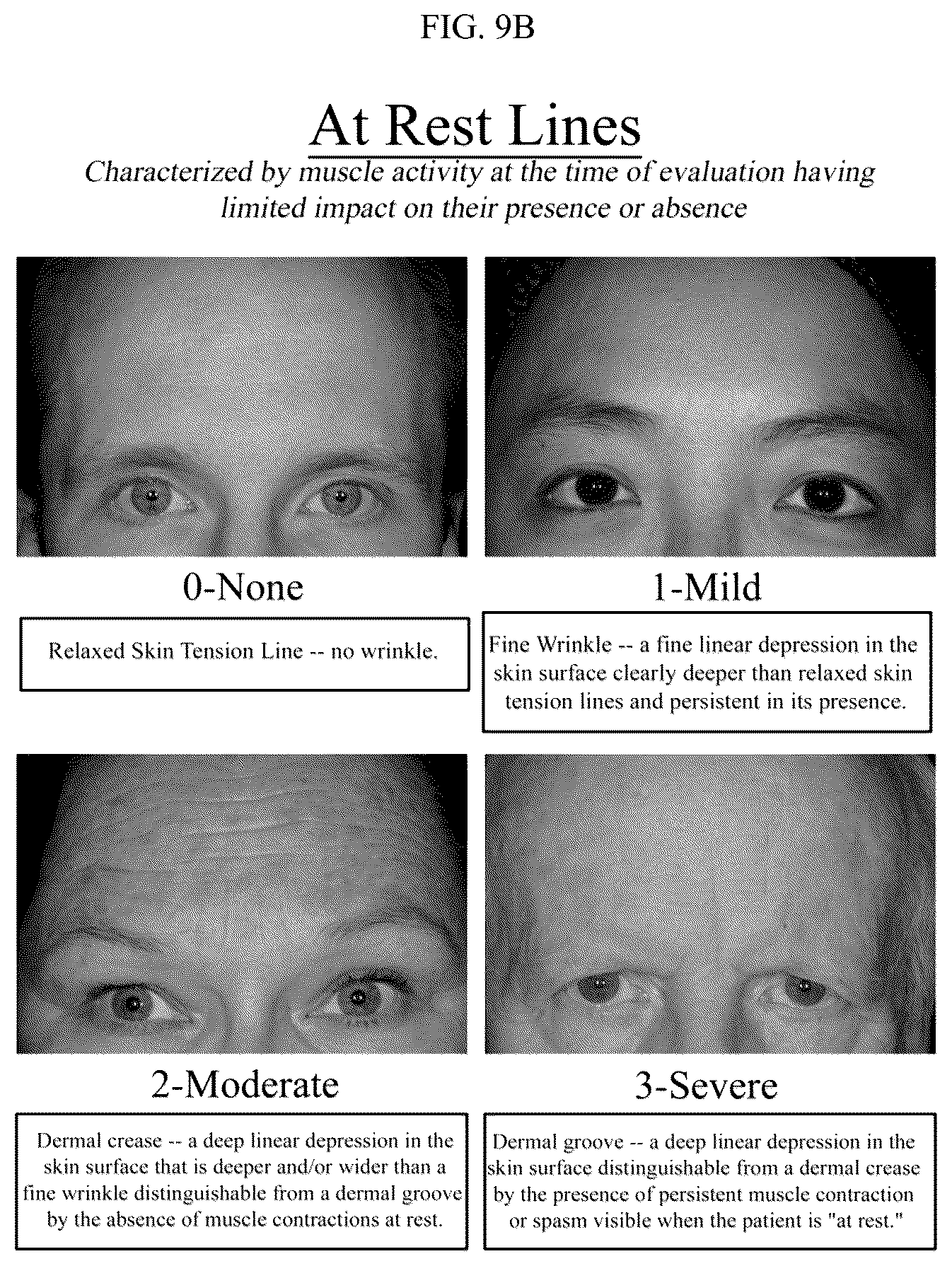 Patent US12599549 Figure 9 – Treatment of moderate to very severe glabellar lines and lateral canthal lines