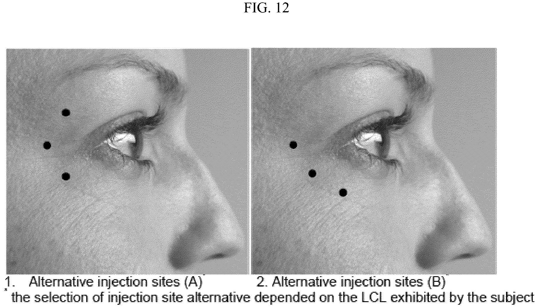 Patent US12599549 Figure 12 – Treatment of moderate to very severe glabellar lines and lateral canthal lines