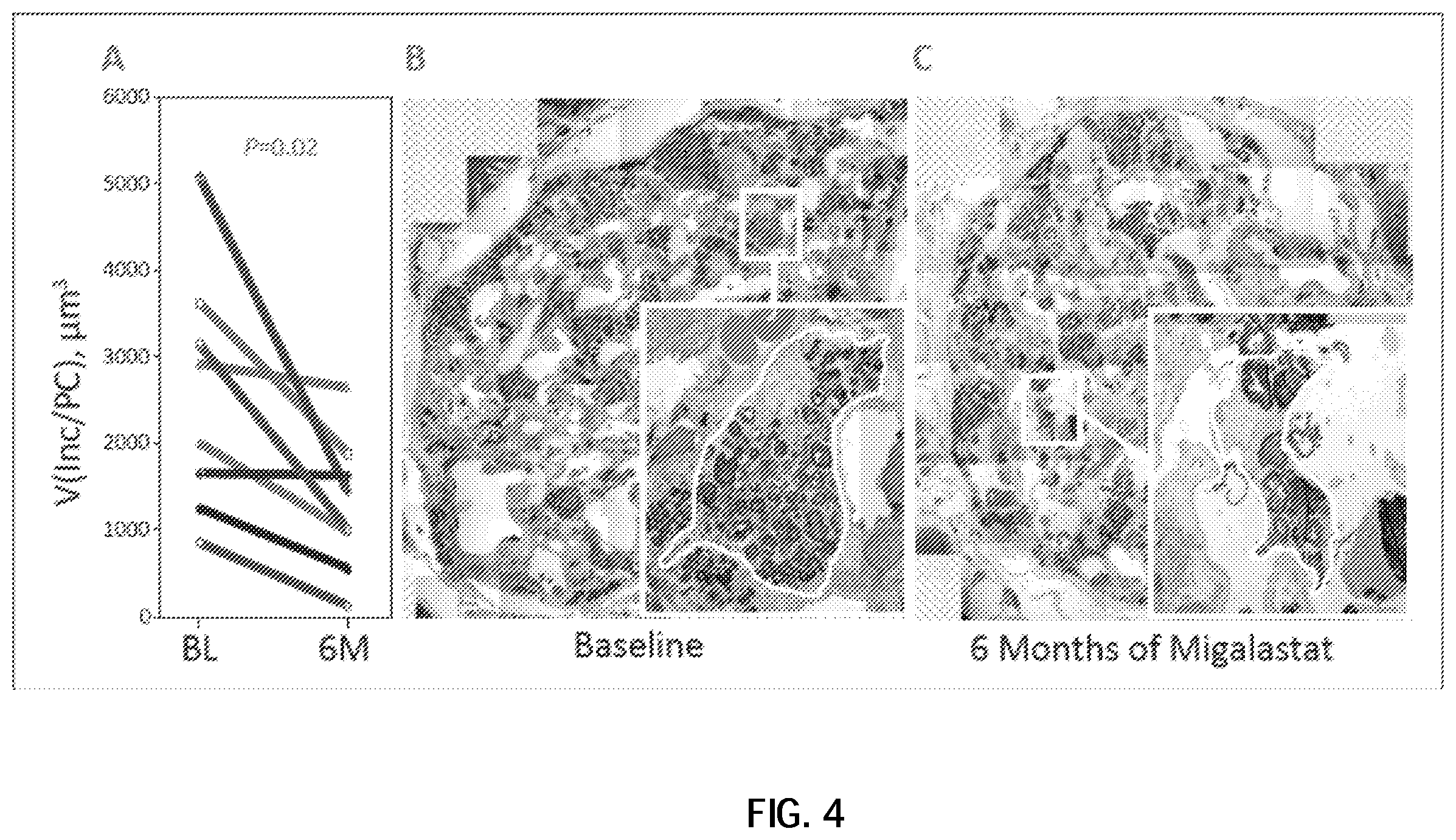 Patent US12599594 Figure 8 – Treatment of Fabry disease in ERT-naïve and ERT-experienced patients