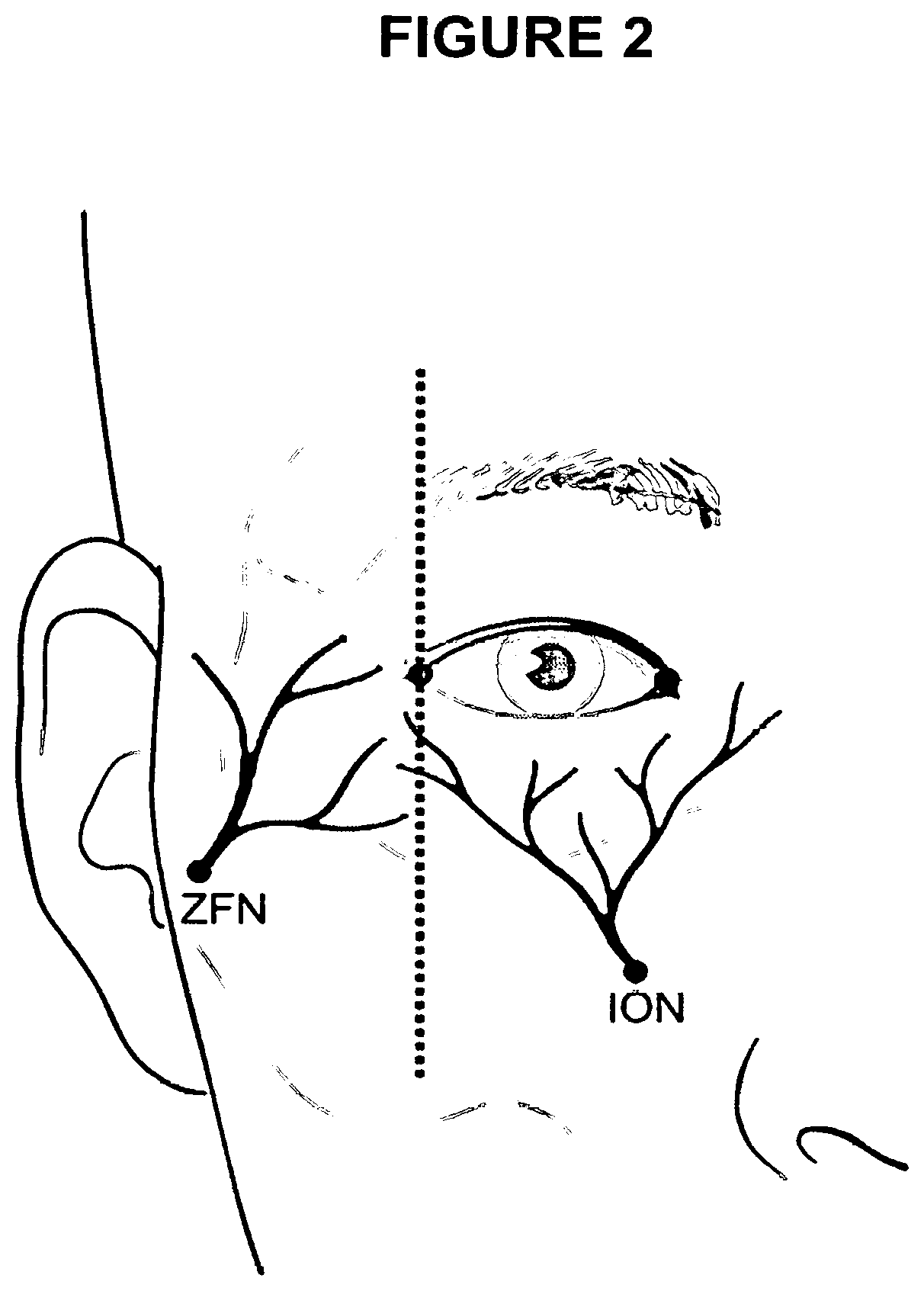 Patent US12599619 Figure 2 – Method of treating blepharitis or conjunctivitis