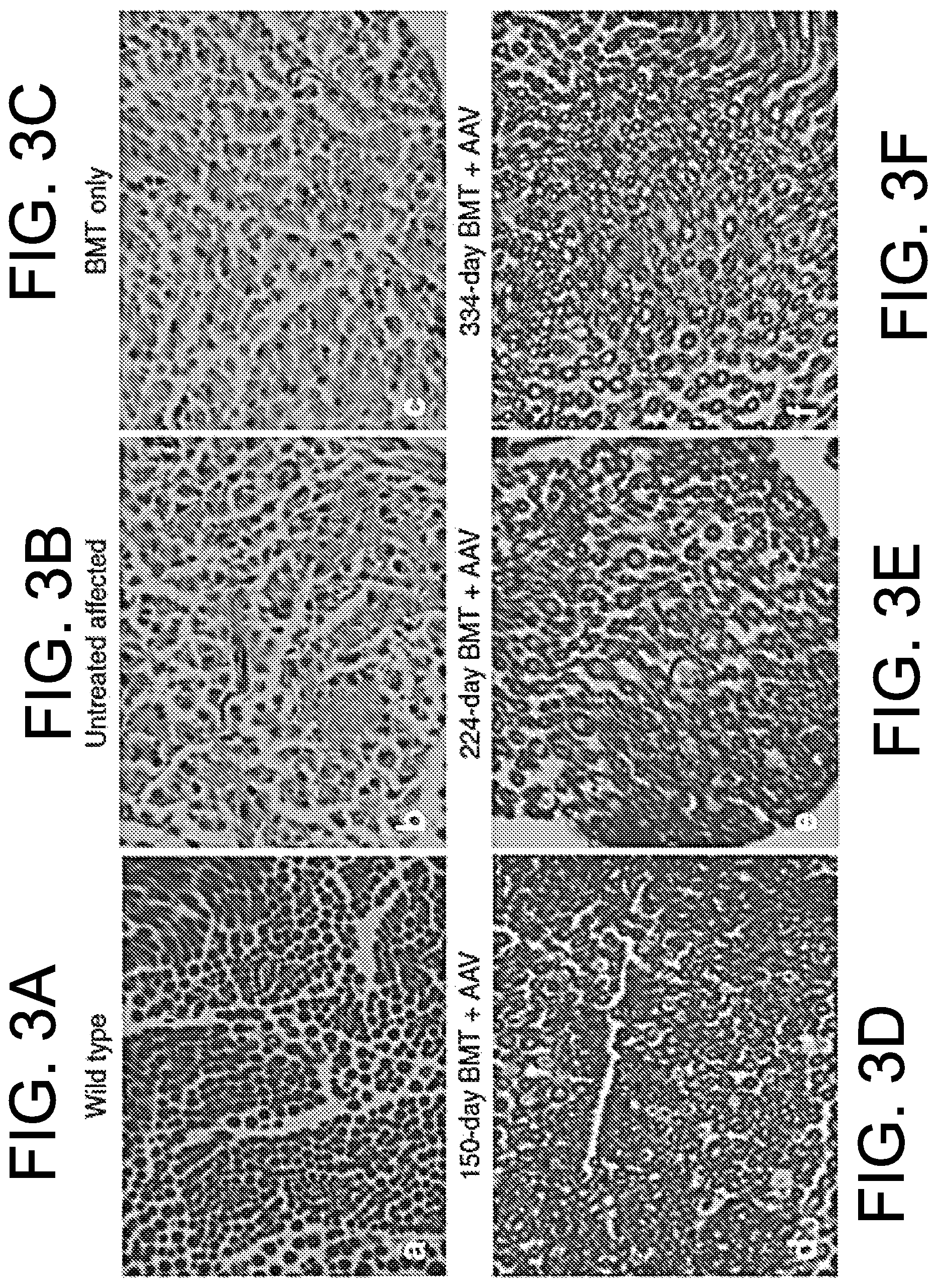 Patent US12599636 Figure 3 – Treatment of Krabbe disease with umbilical cord blood transplantion (UCBT) and increased galactocerebrosidase (GALC) expression