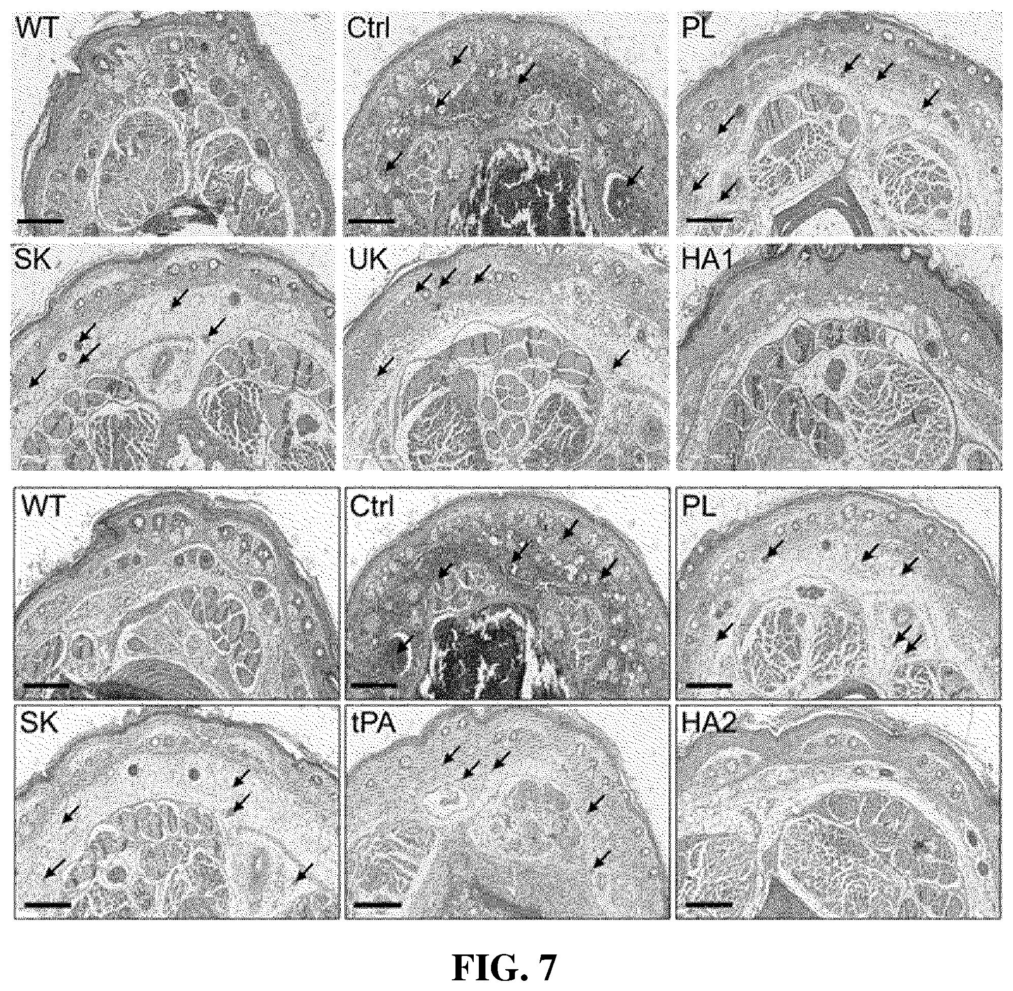 Patent US12599653 Figure 6 – Thrombolytic agents for intravascular clots