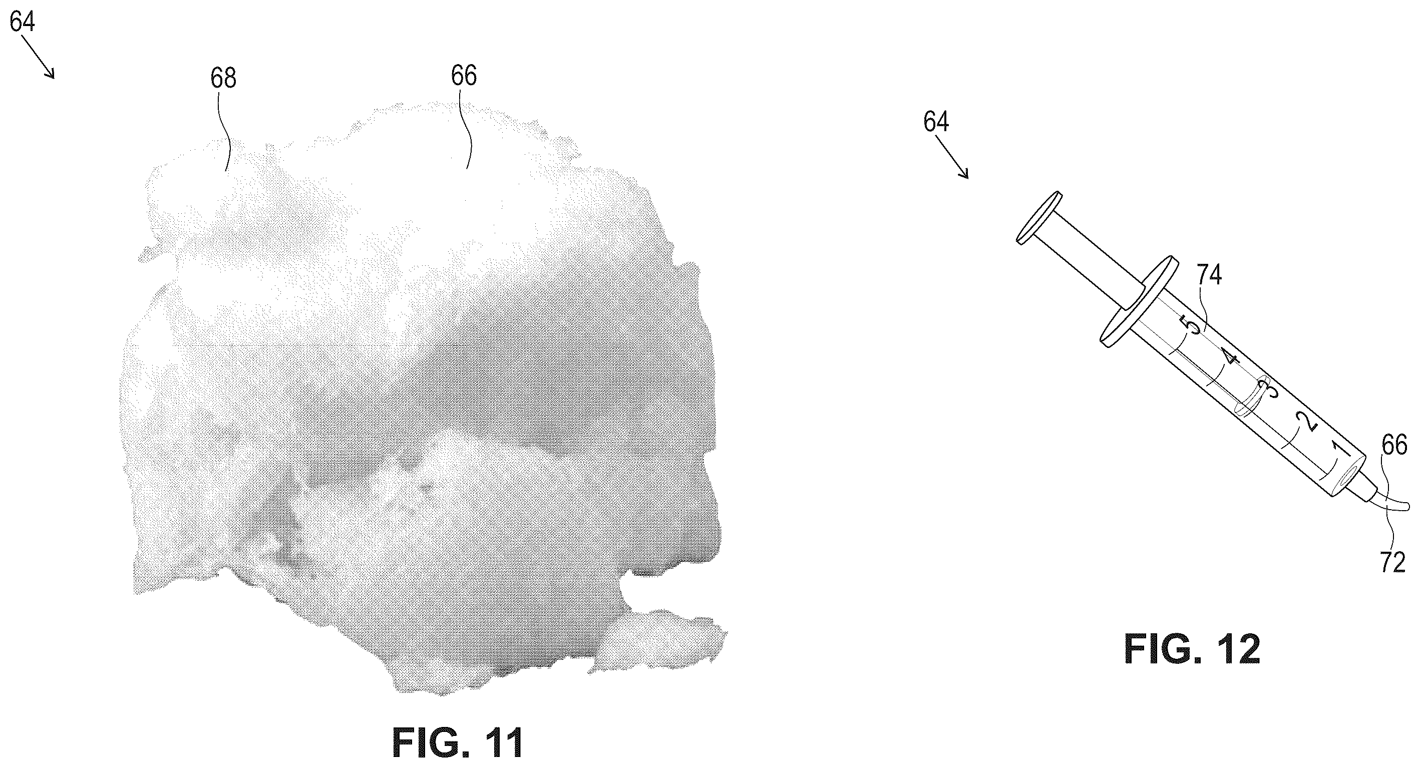 Patent US12599696 Figure 11 – Hydratable and flowable implantable compositions and methods of making and using them