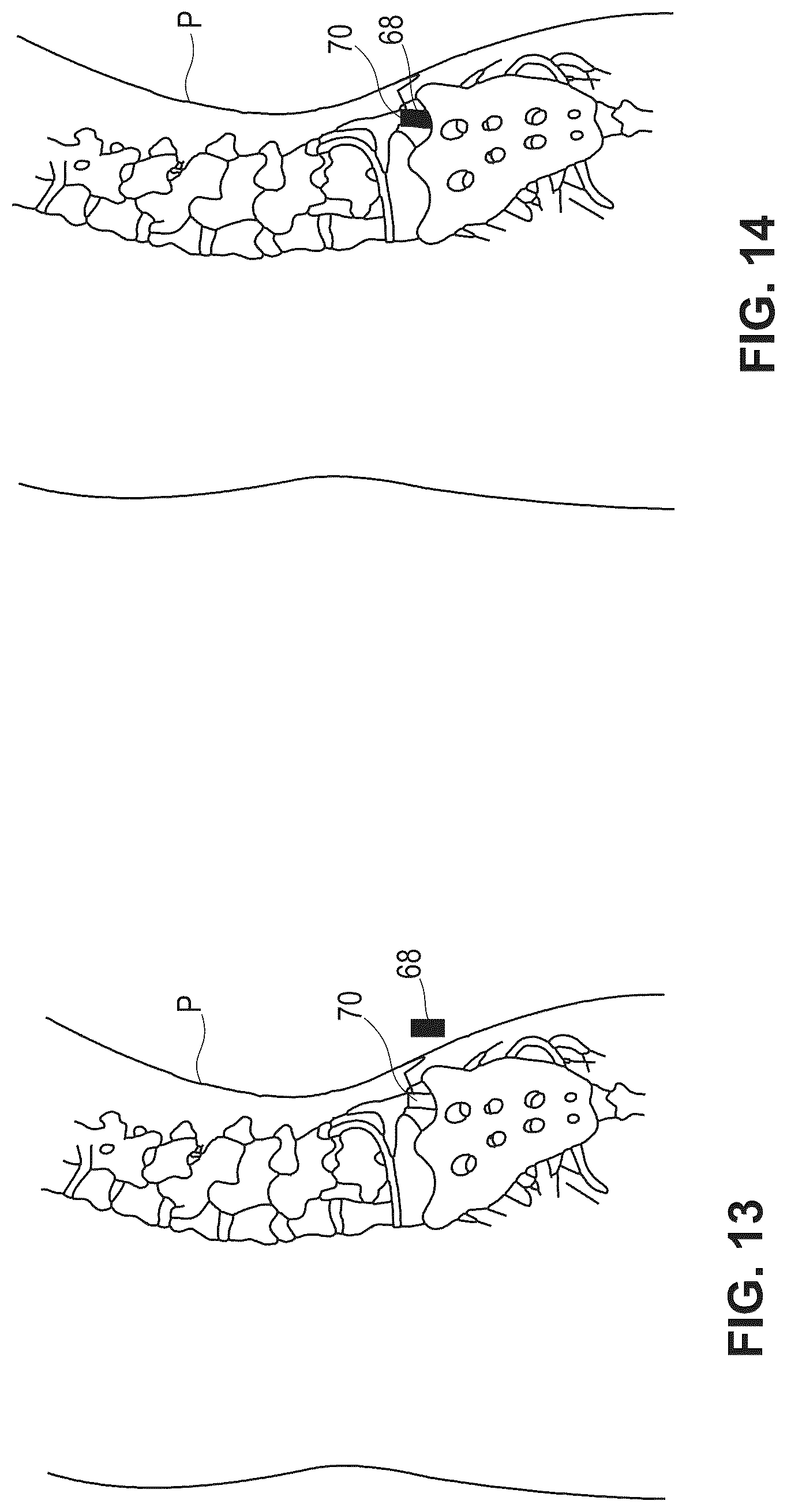 Patent US12599696 Figure 12 – Hydratable and flowable implantable compositions and methods of making and using them