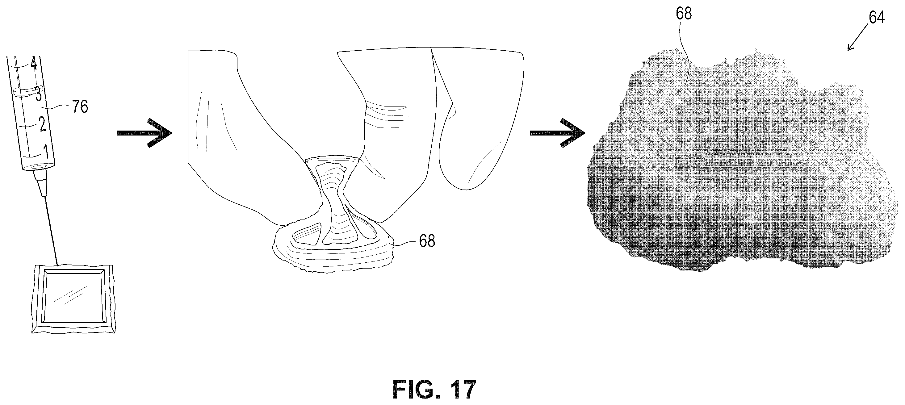 Patent US12599696 Figure 14 – Hydratable and flowable implantable compositions and methods of making and using them
