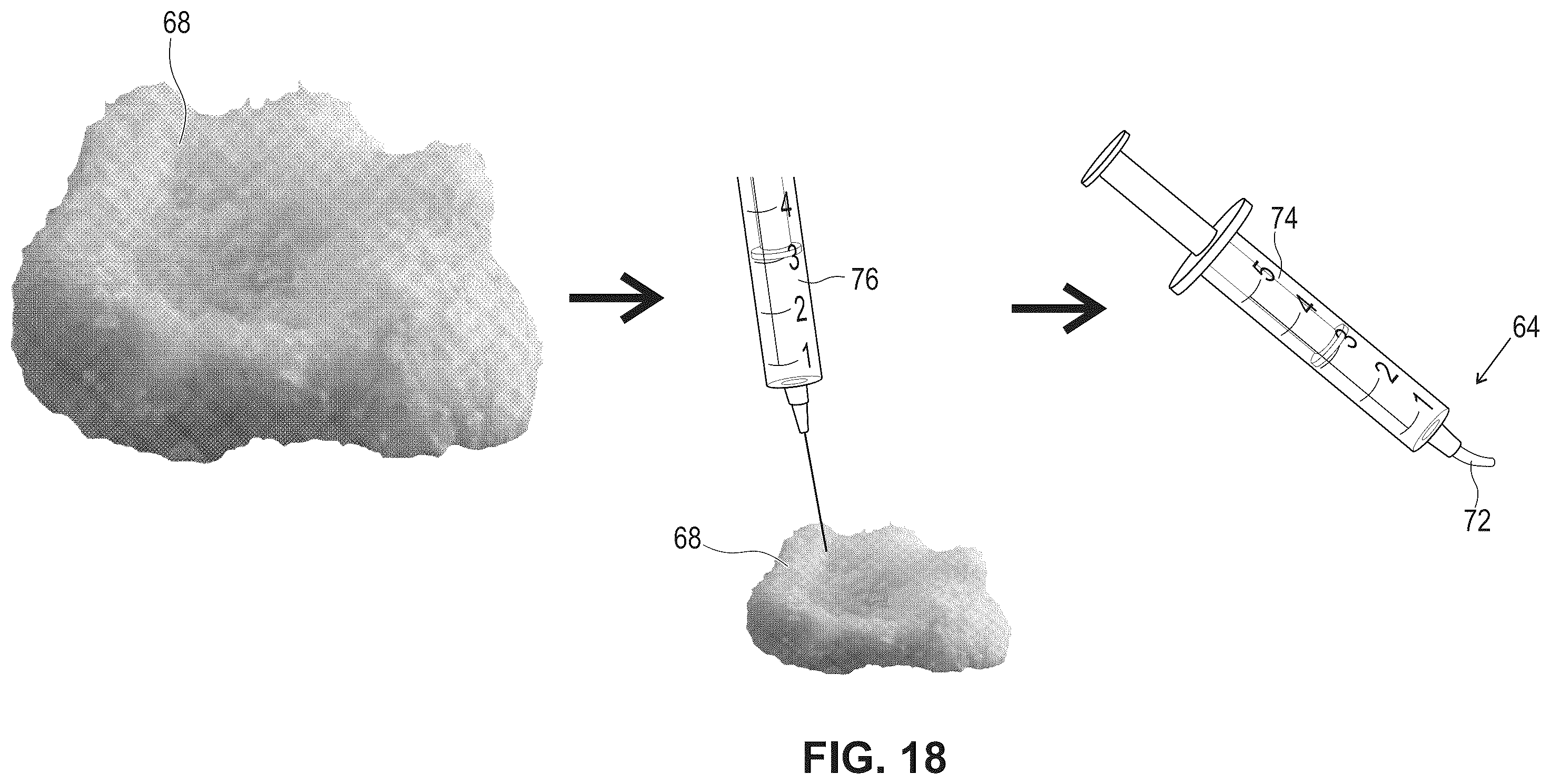 Patent US12599696 Figure 15 – Hydratable and flowable implantable compositions and methods of making and using them