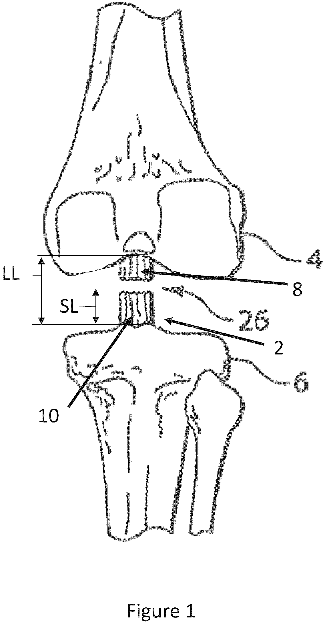 Patent US12599700 Figure 1 – System and methods for connective tissue repair using scaffolds