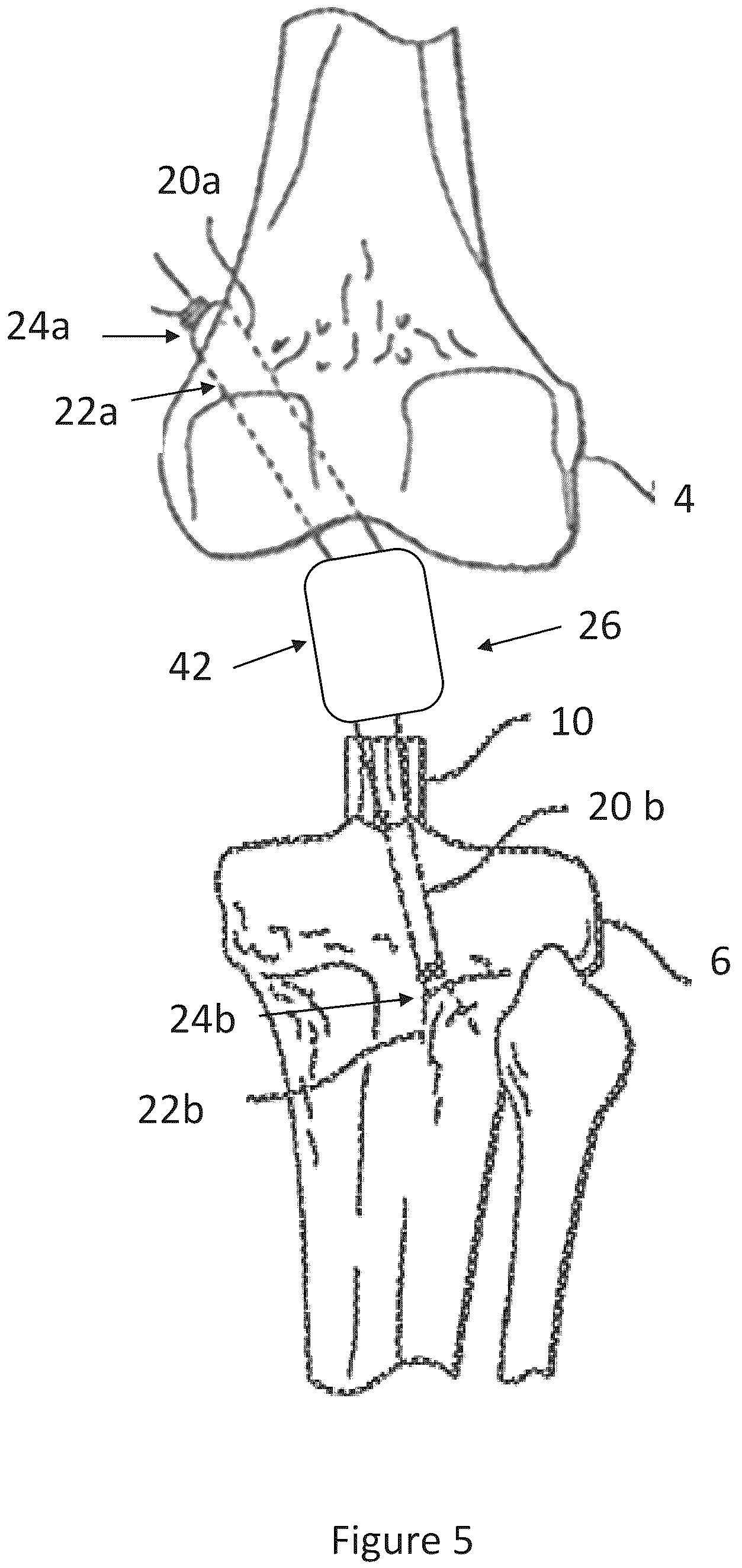 Patent US12599700 Figure 5 – System and methods for connective tissue repair using scaffolds