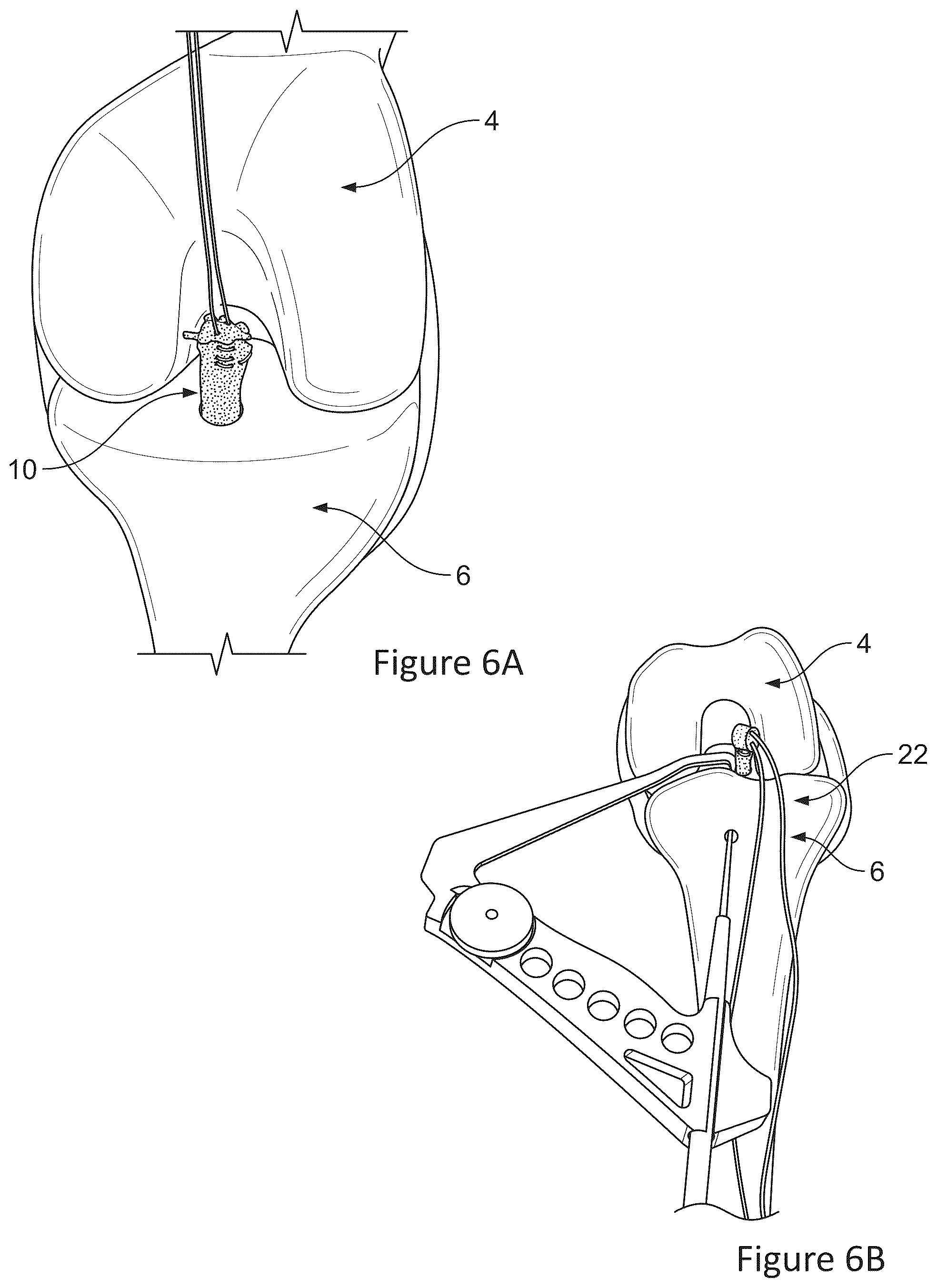 Patent US12599700 Figure 6 – System and methods for connective tissue repair using scaffolds