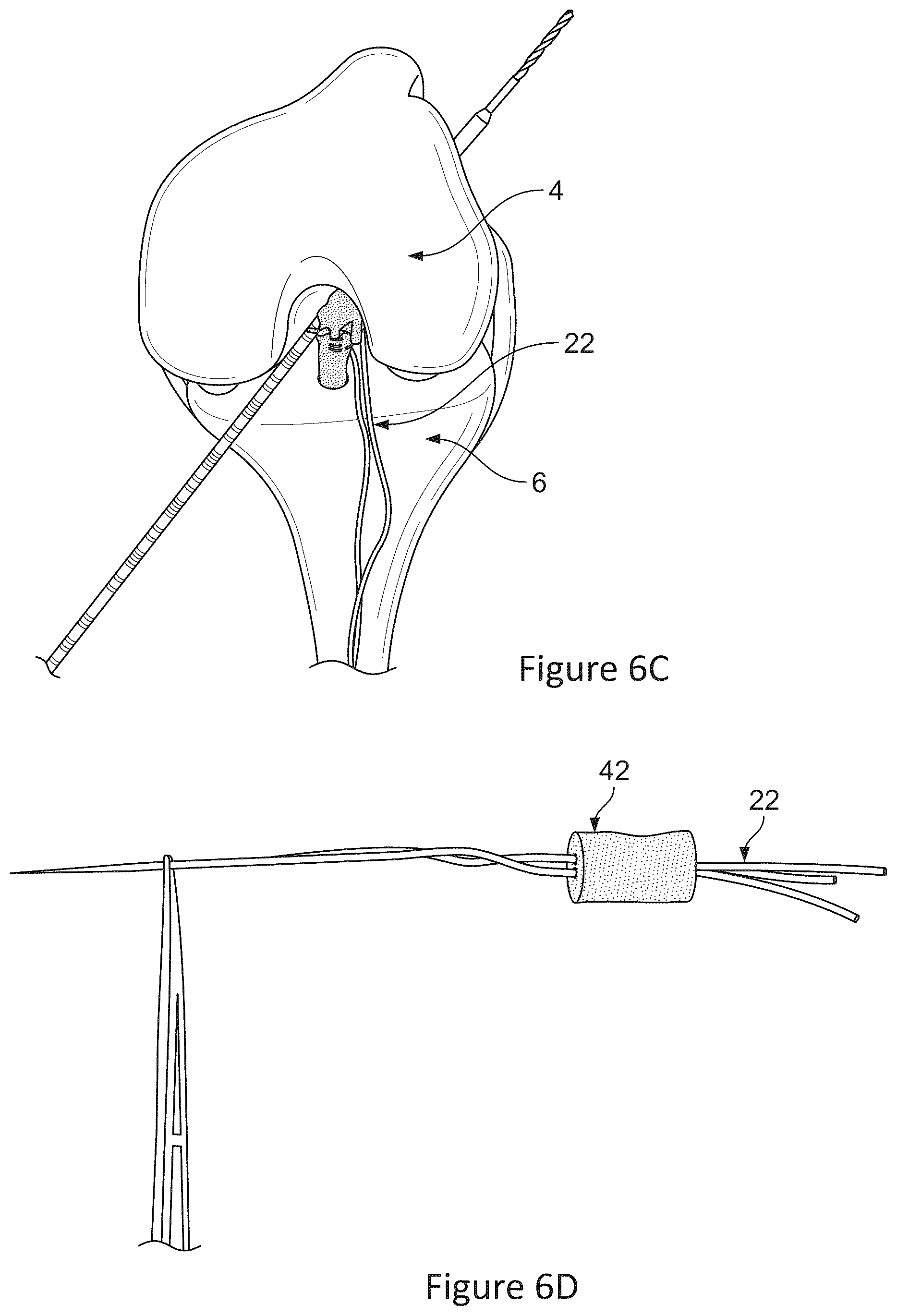 Patent US12599700 Figure 7 – System and methods for connective tissue repair using scaffolds