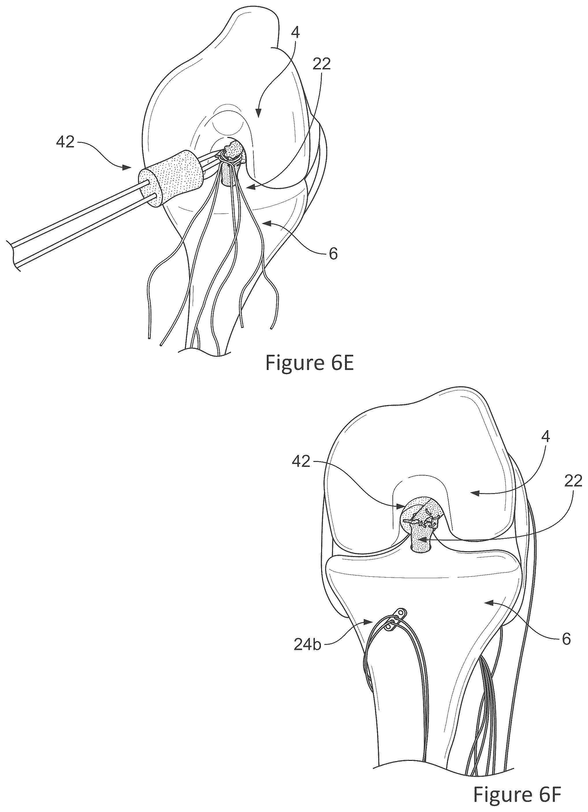 Patent US12599700 Figure 8 – System and methods for connective tissue repair using scaffolds