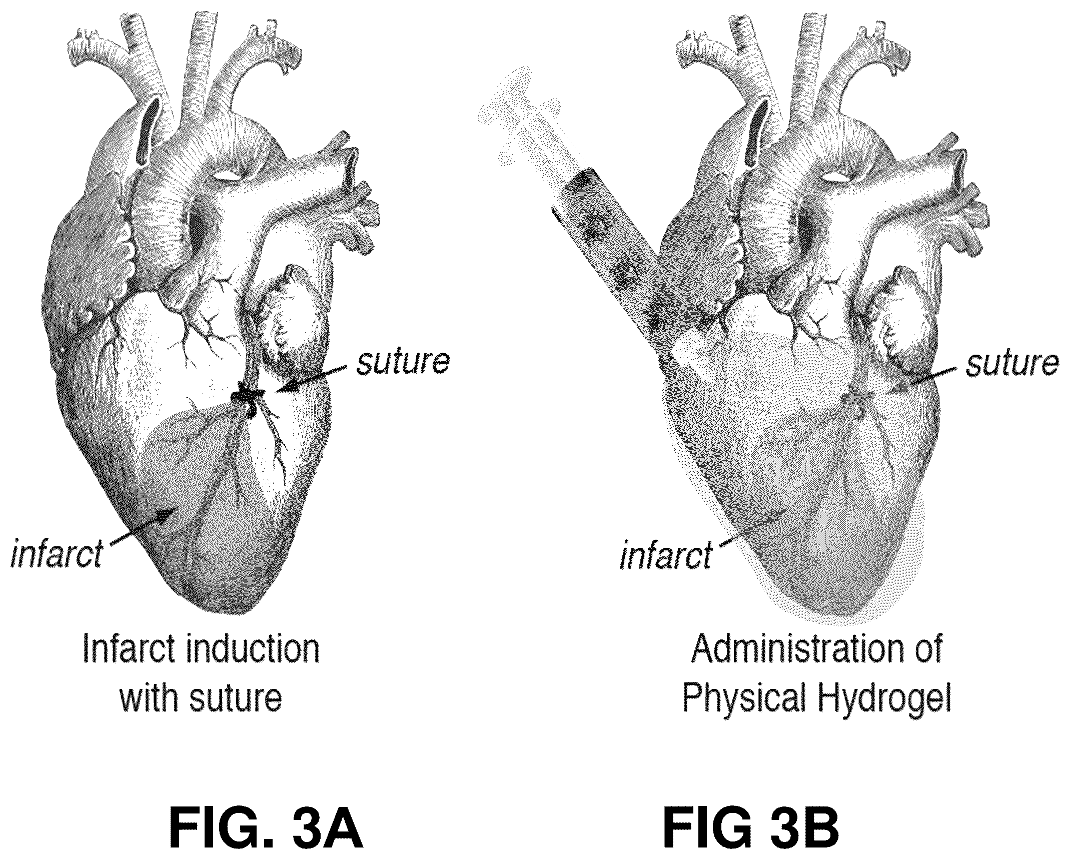 Patent US12599706 Figure 3 – Adhesion prevention with shear-thinning polymeric hydrogels