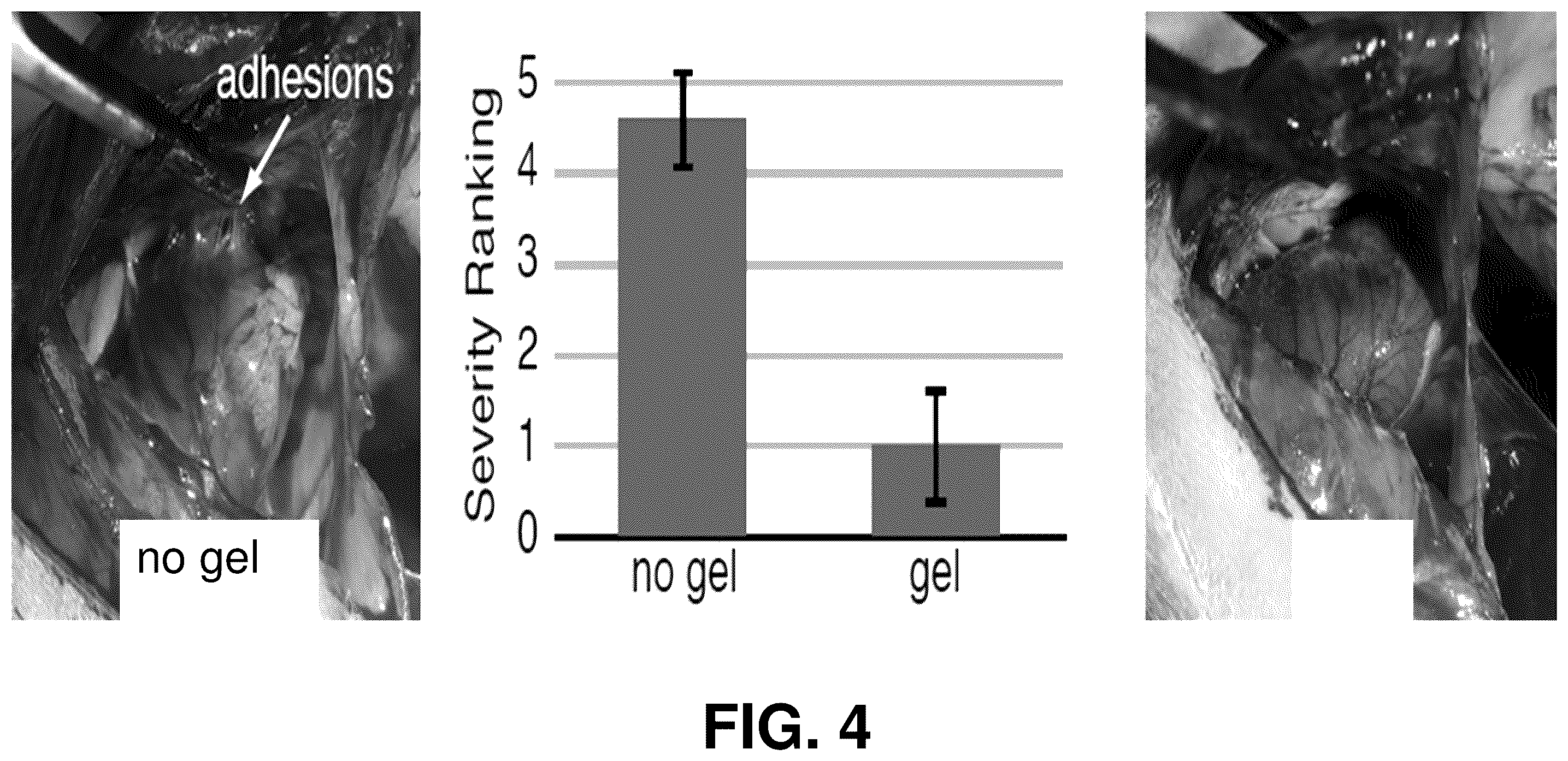 Patent US12599706 Figure 4 – Adhesion prevention with shear-thinning polymeric hydrogels