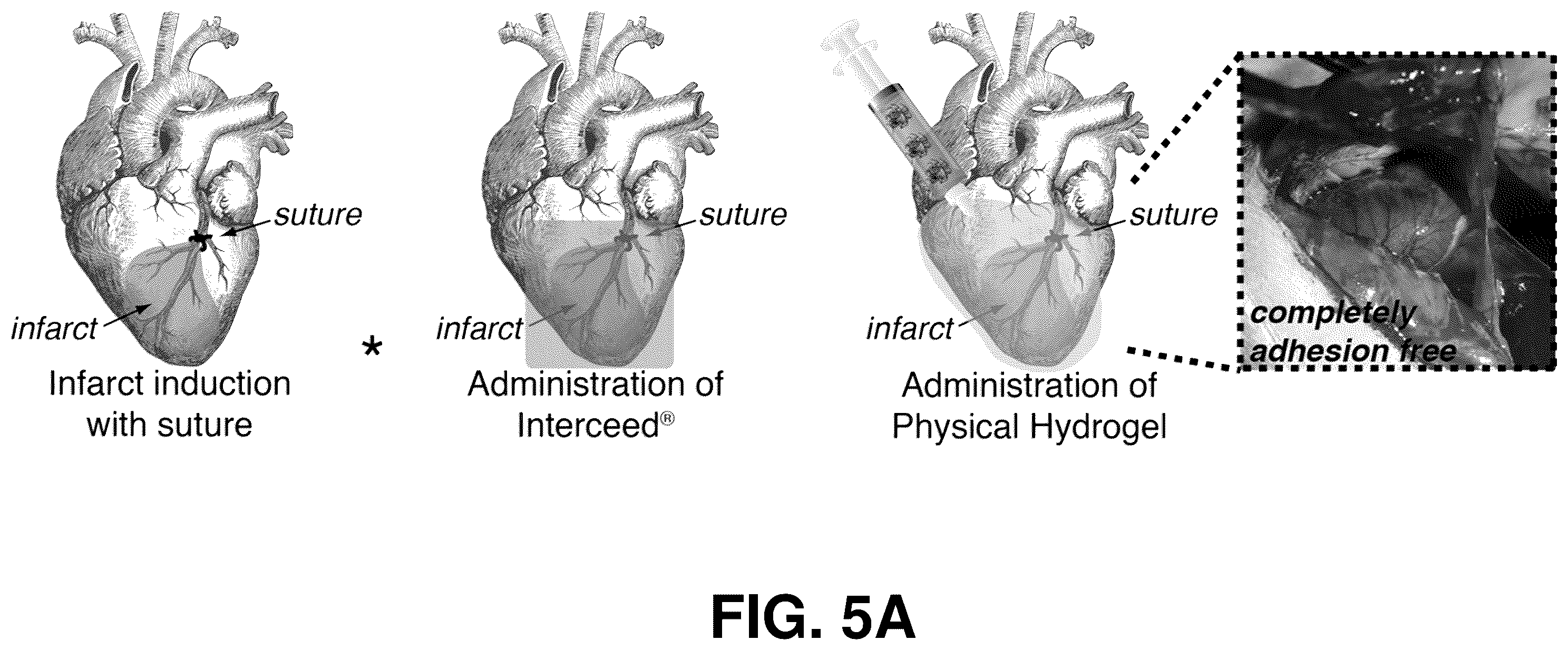 Patent US12599706 Figure 5 – Adhesion prevention with shear-thinning polymeric hydrogels