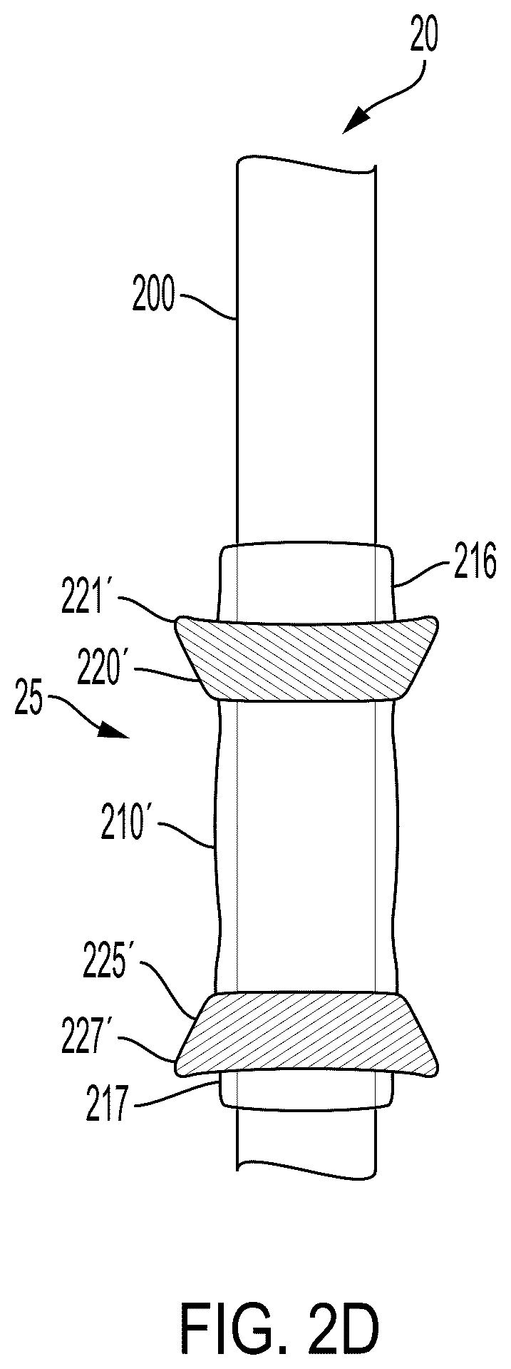 Patent US12599736 Figure 5 – System and method for avoiding leakage in endotracheal tube with single or double cuff