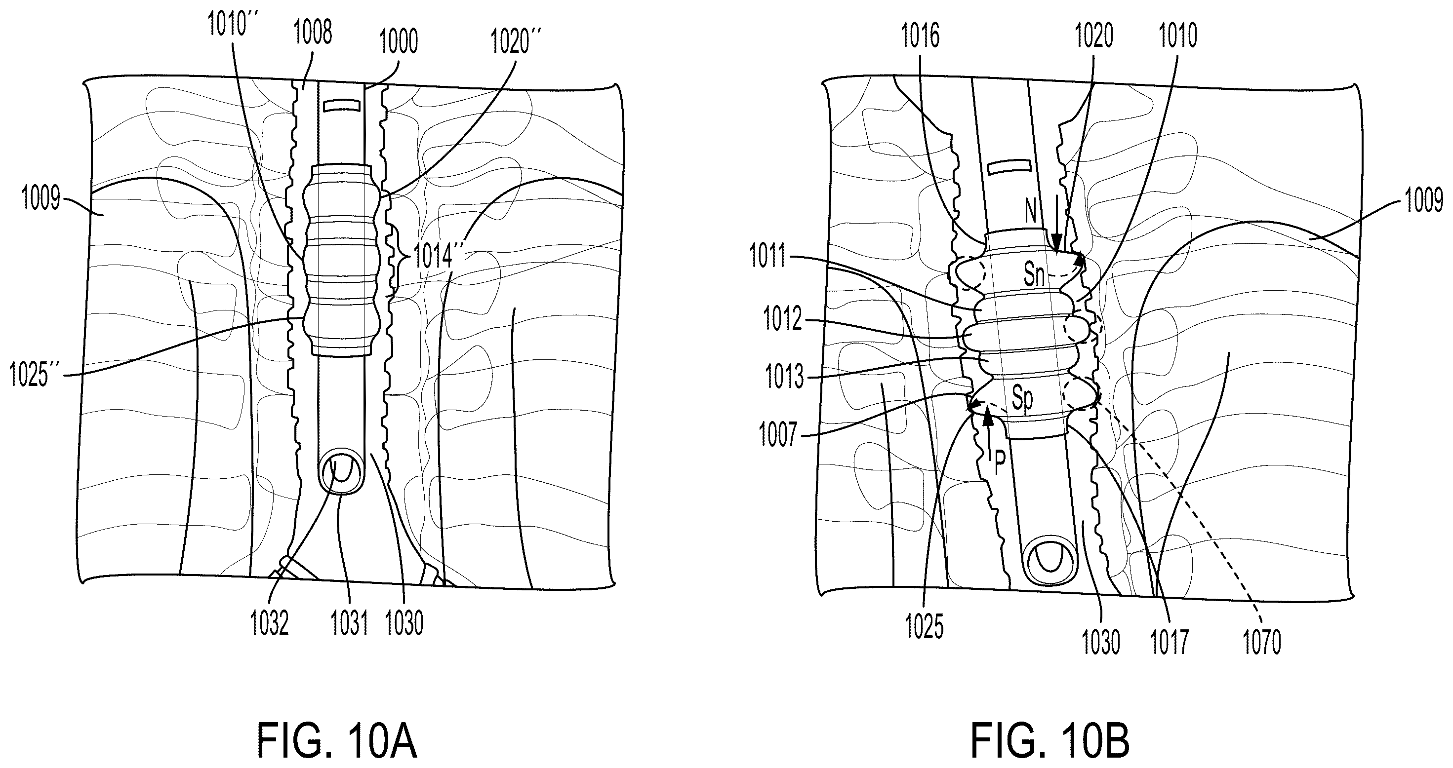 Patent US12599736 Figure 13 – System and method for avoiding leakage in endotracheal tube with single or double cuff