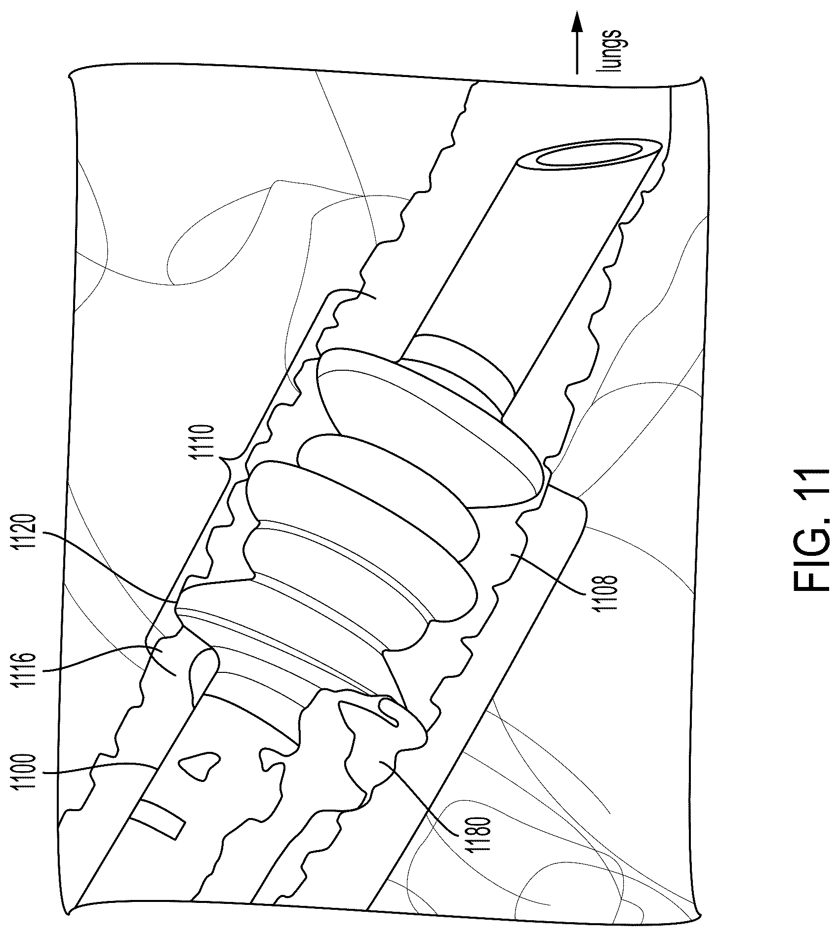 Patent US12599736 Figure 14 – System and method for avoiding leakage in endotracheal tube with single or double cuff