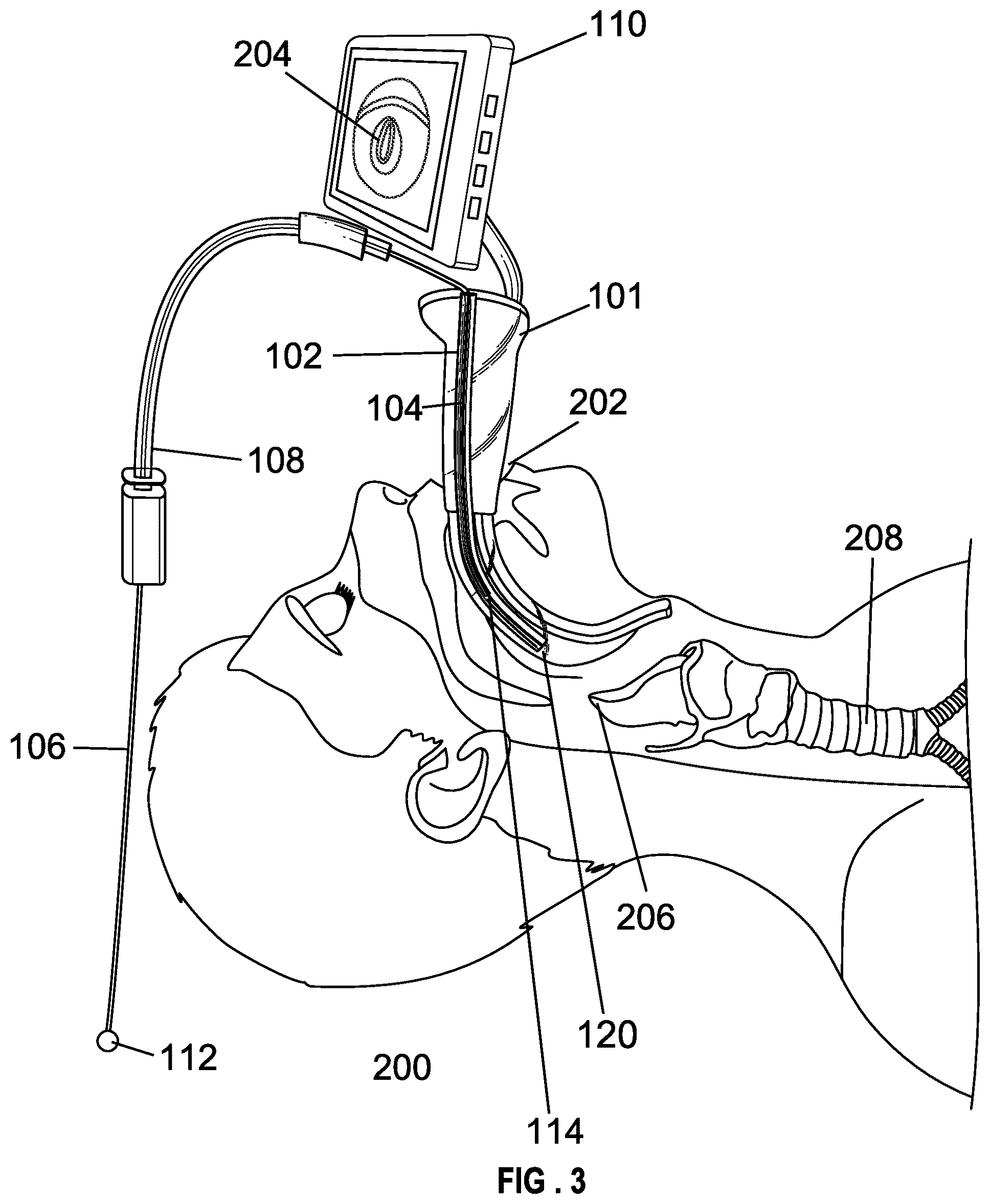 Patent US12599737 Figure 3 – Laryngoscope blade with a channel