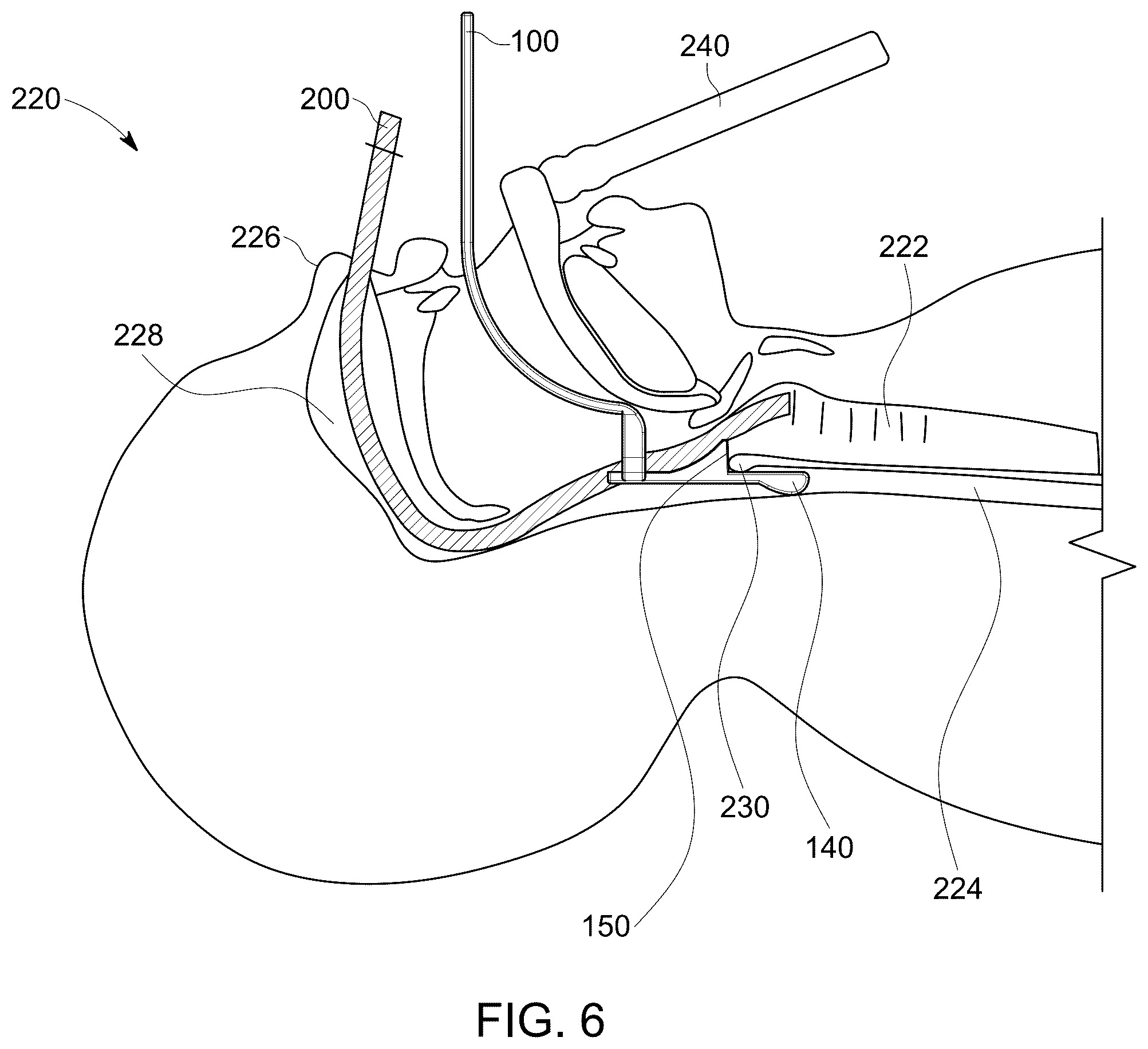 Patent US12599738 Figure 6 – Oral and nasal tracheal intubation assistance device