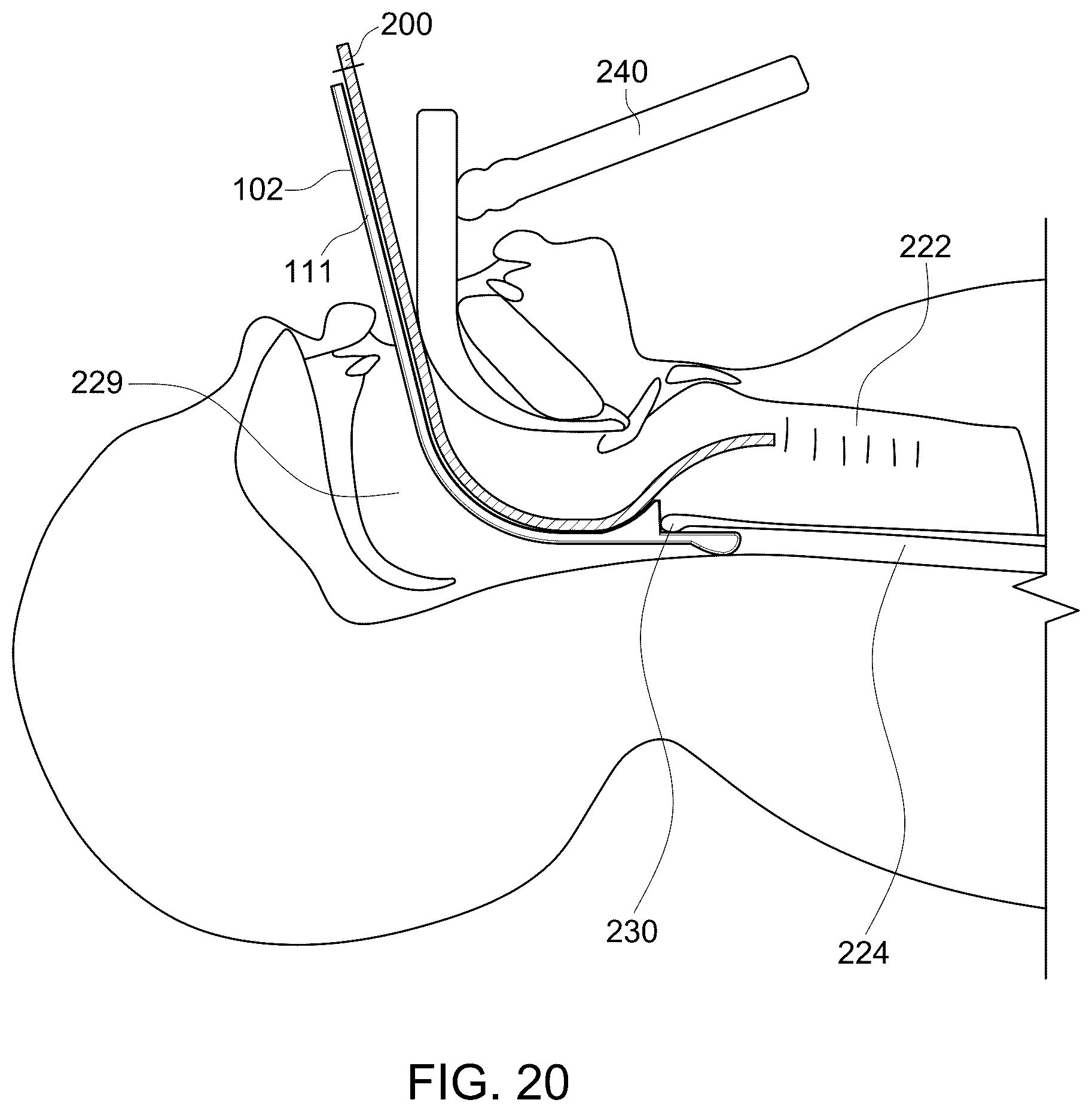 Patent US12599738 Figure 19 – Oral and nasal tracheal intubation assistance device