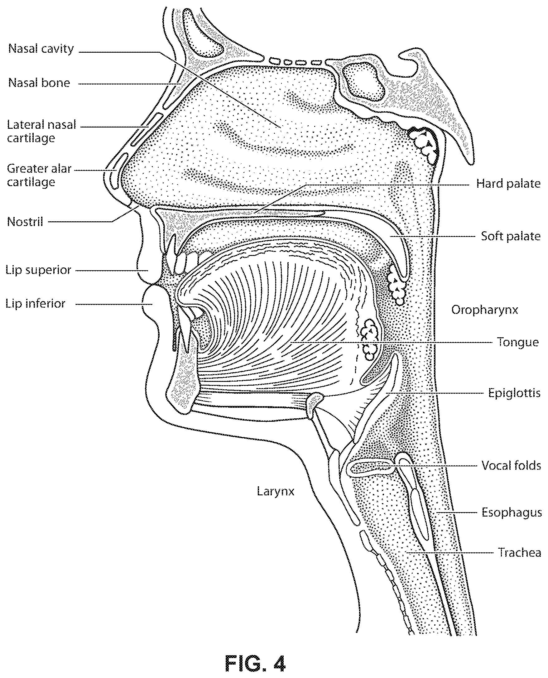 Patent US12599739 Figure 4 – Patient interface with foam cushion