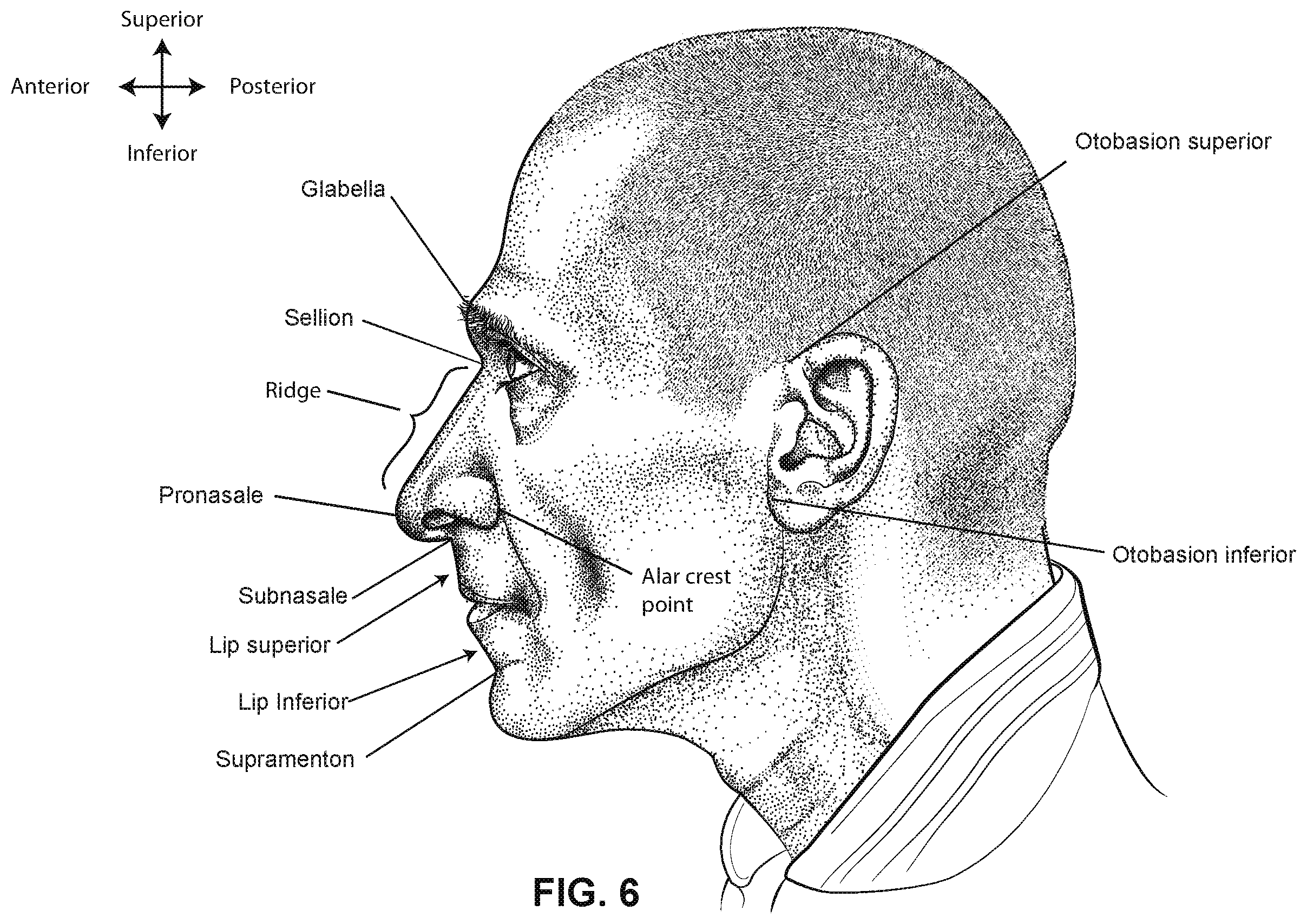 Patent US12599739 Figure 6 – Patient interface with foam cushion