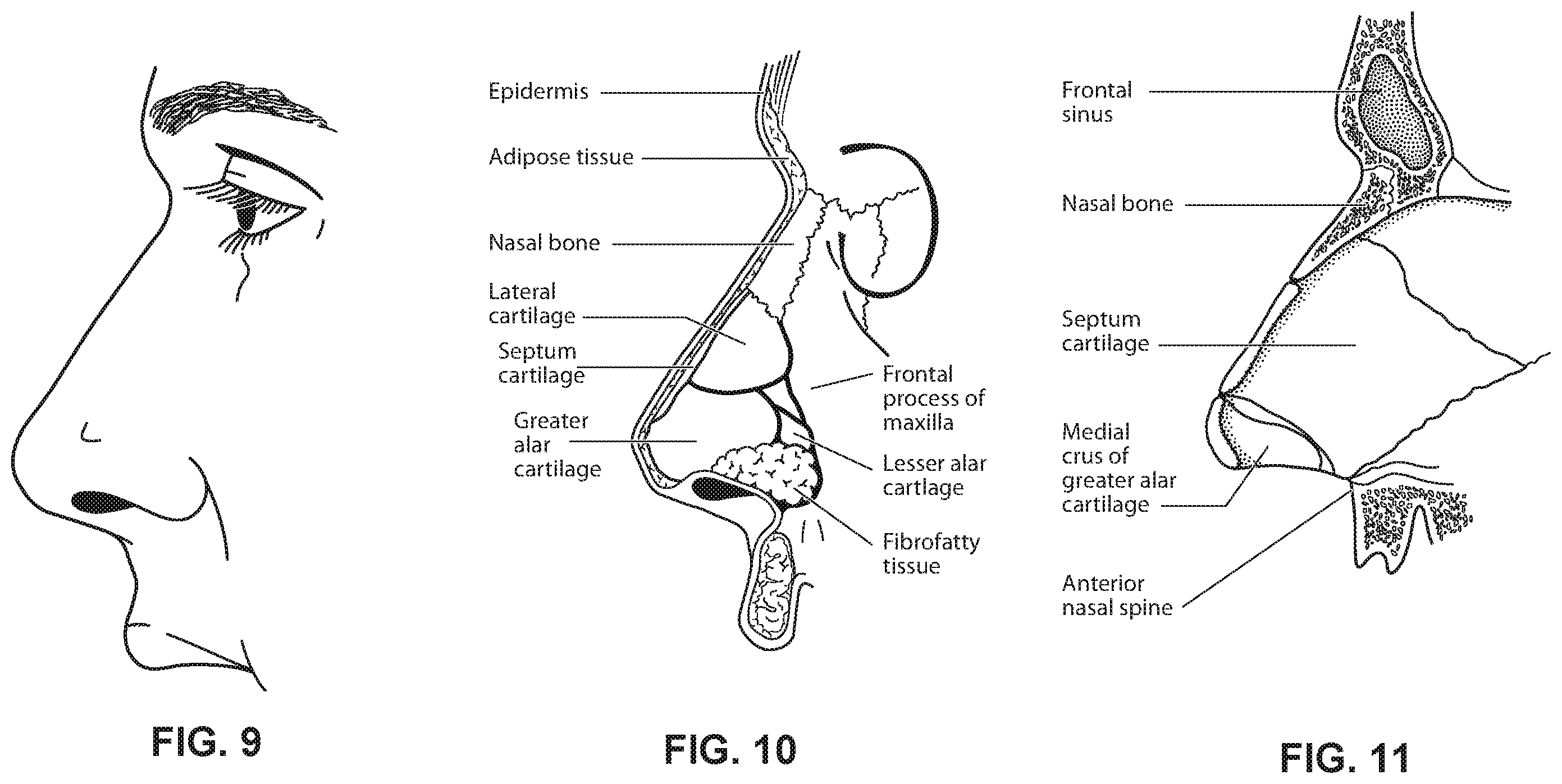 Patent US12599739 Figure 9 – Patient interface with foam cushion
