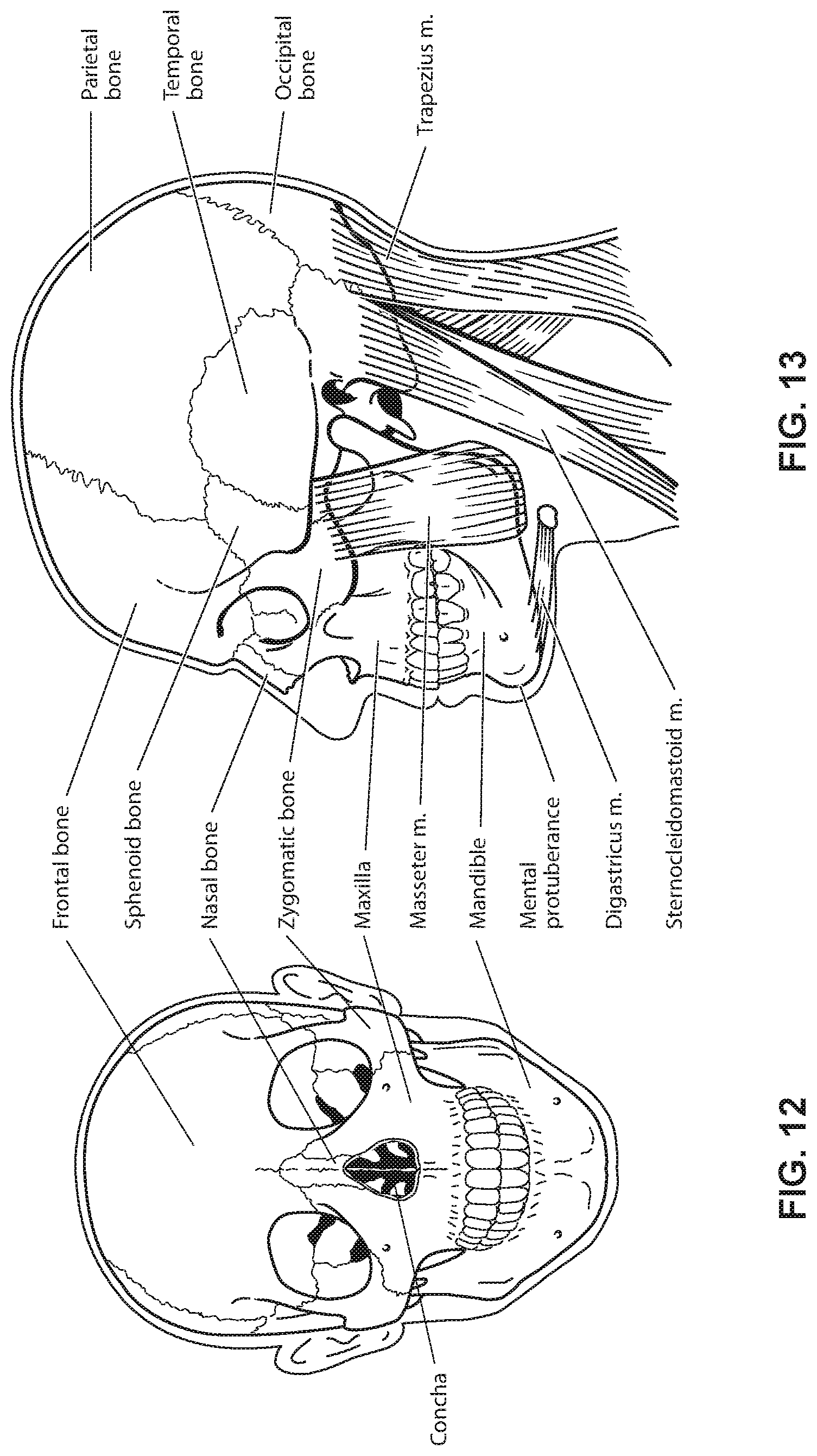 Patent US12599739 Figure 10 – Patient interface with foam cushion