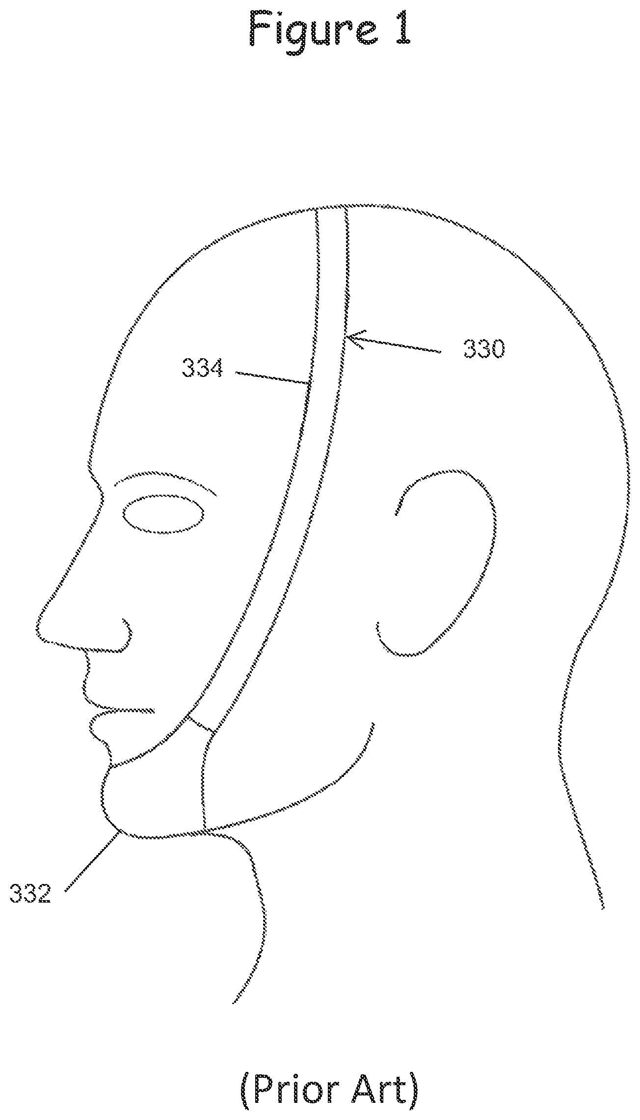 Patent US12599740 Figure 1 – Oral appliance for use with CPAP headgear
